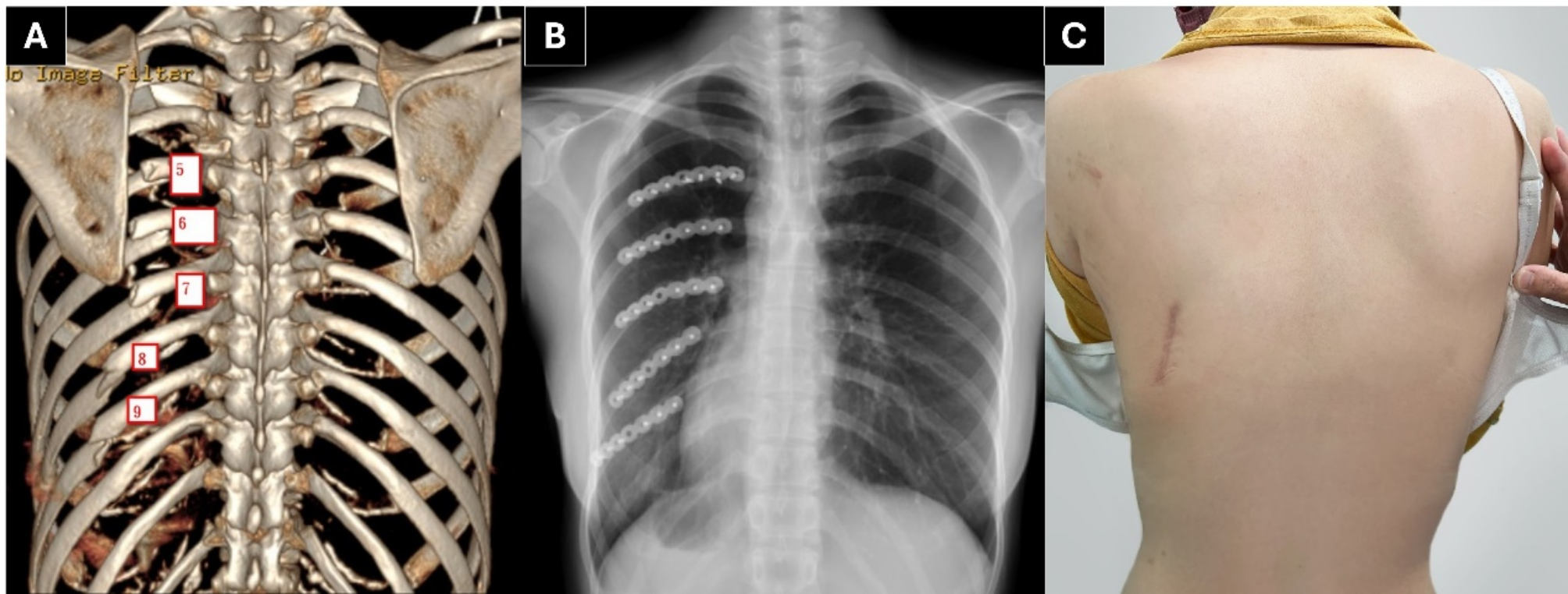 Ultra minimally invasive surgical stabilization of Rib fractures (uMI-SSRF): reduction and fixation techniques to minimize the surgical wound