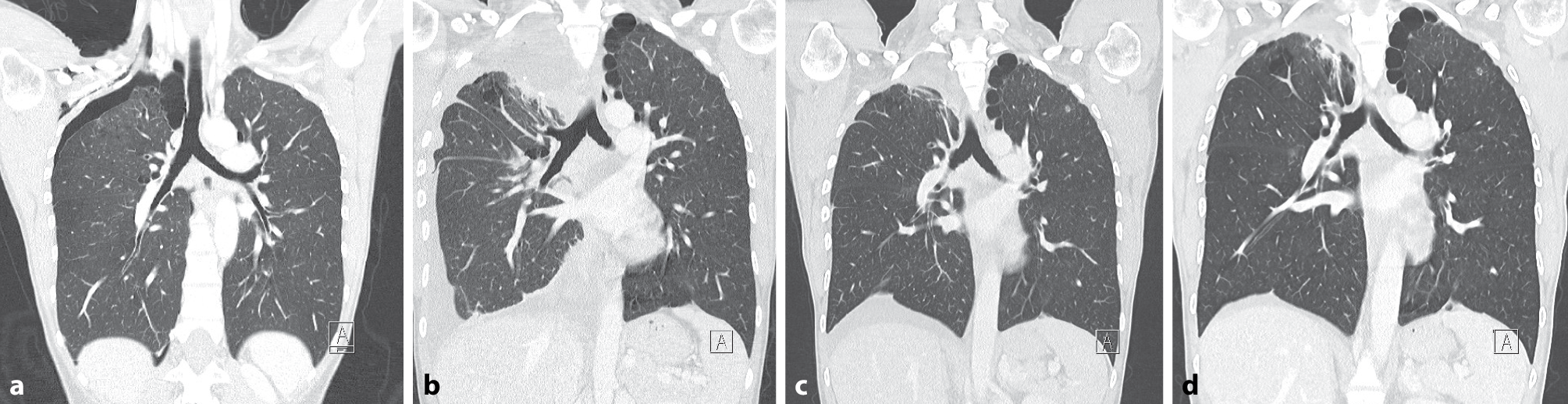 Alternating chemotherapy with VDC-IE as effective first-line treatment in a patient with SMARCA4-deficient undifferentiated tumor