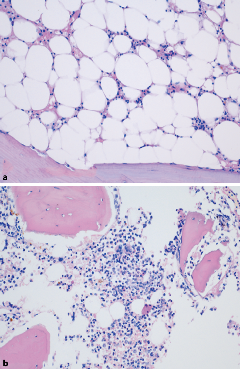 Importance of genetic clarification in cytopenia syndromes (childhood myelodysplastic syndrome forms)