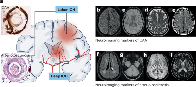 Intracerebral haemorrhage — mechanisms, diagnosis and prospects for treatment and prevention