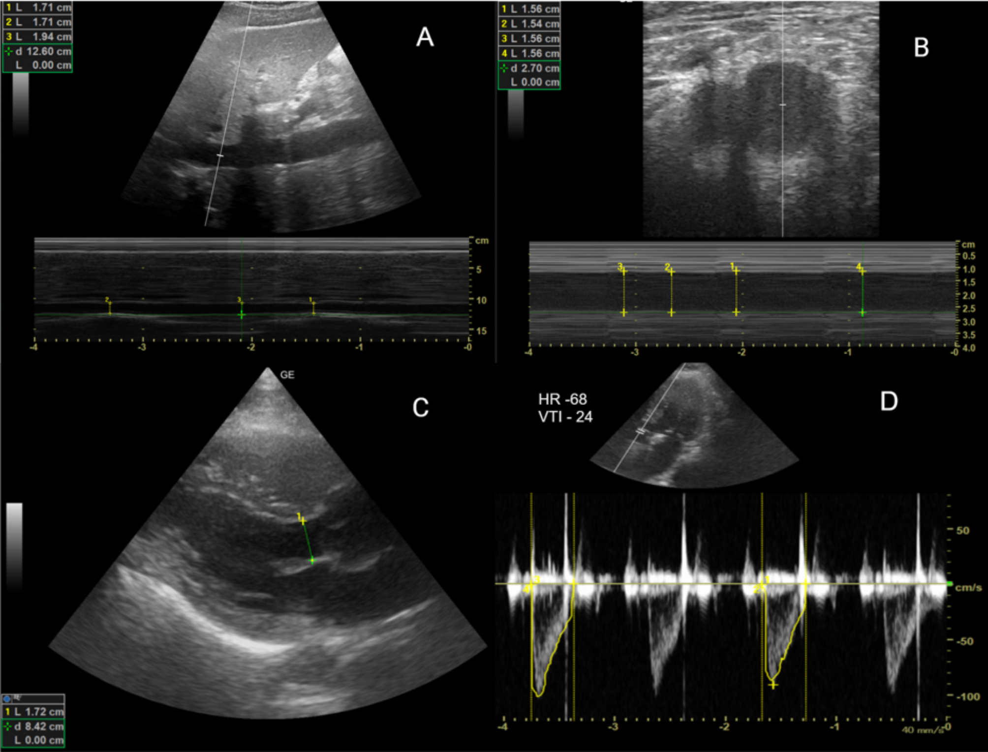 Volume assessment comparing femoral vein and inferior vena cava among chest pain patients presenting to the emergency department