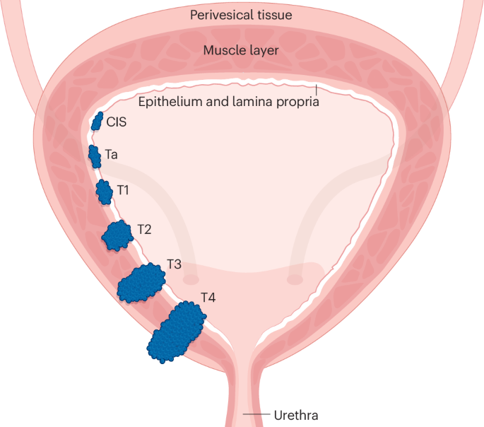 Metastasis development in non-muscle-invasive bladder cancer