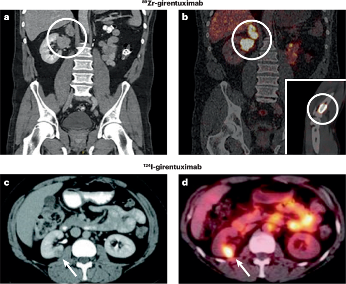 Molecular imaging of renal cell carcinomas: ready for prime time