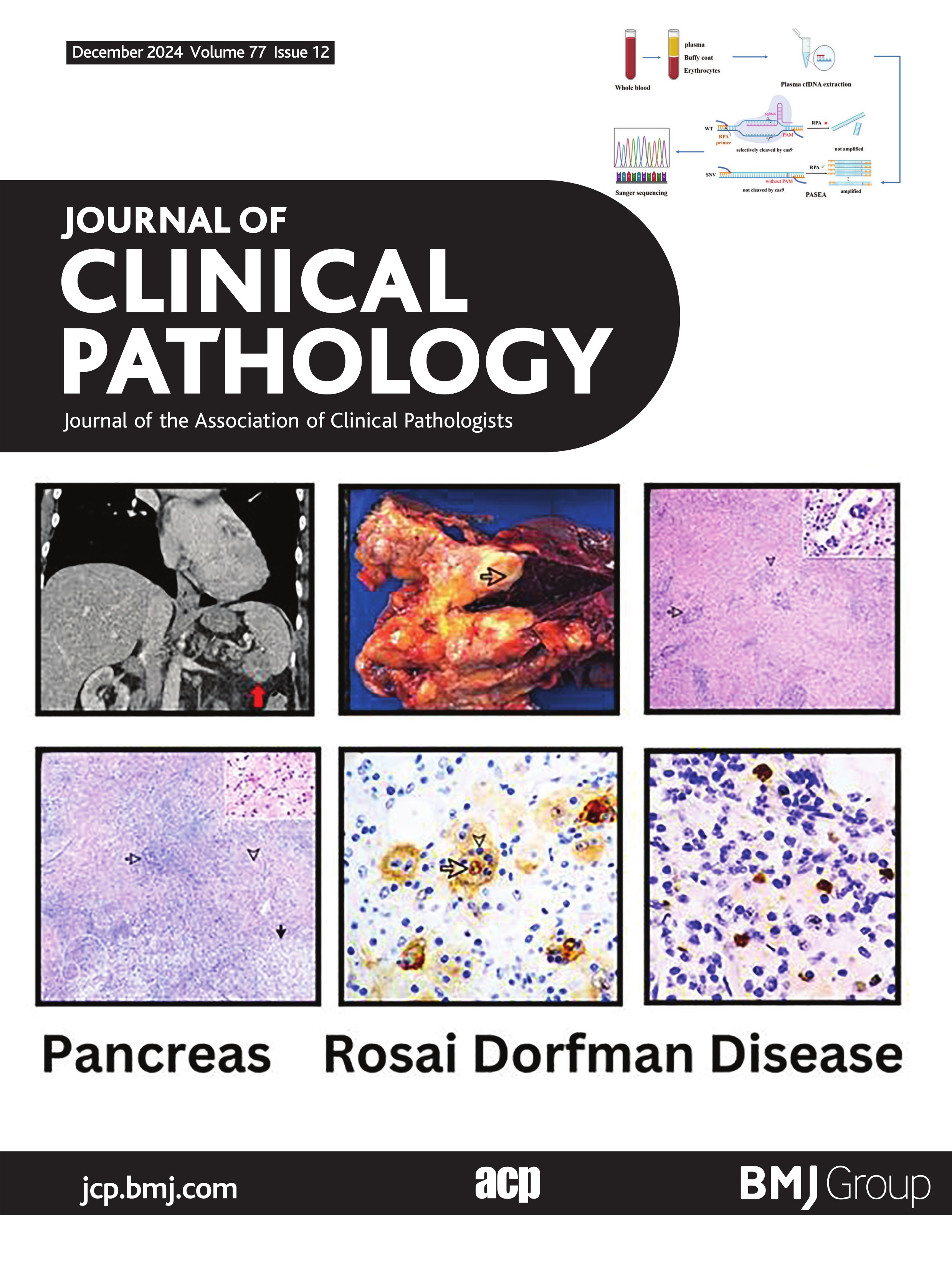 Optimal carcinoembryonic antigen (CEA) cutoff values in the diagnosis of neoplastic mucinous pancreatic cysts differ among assays