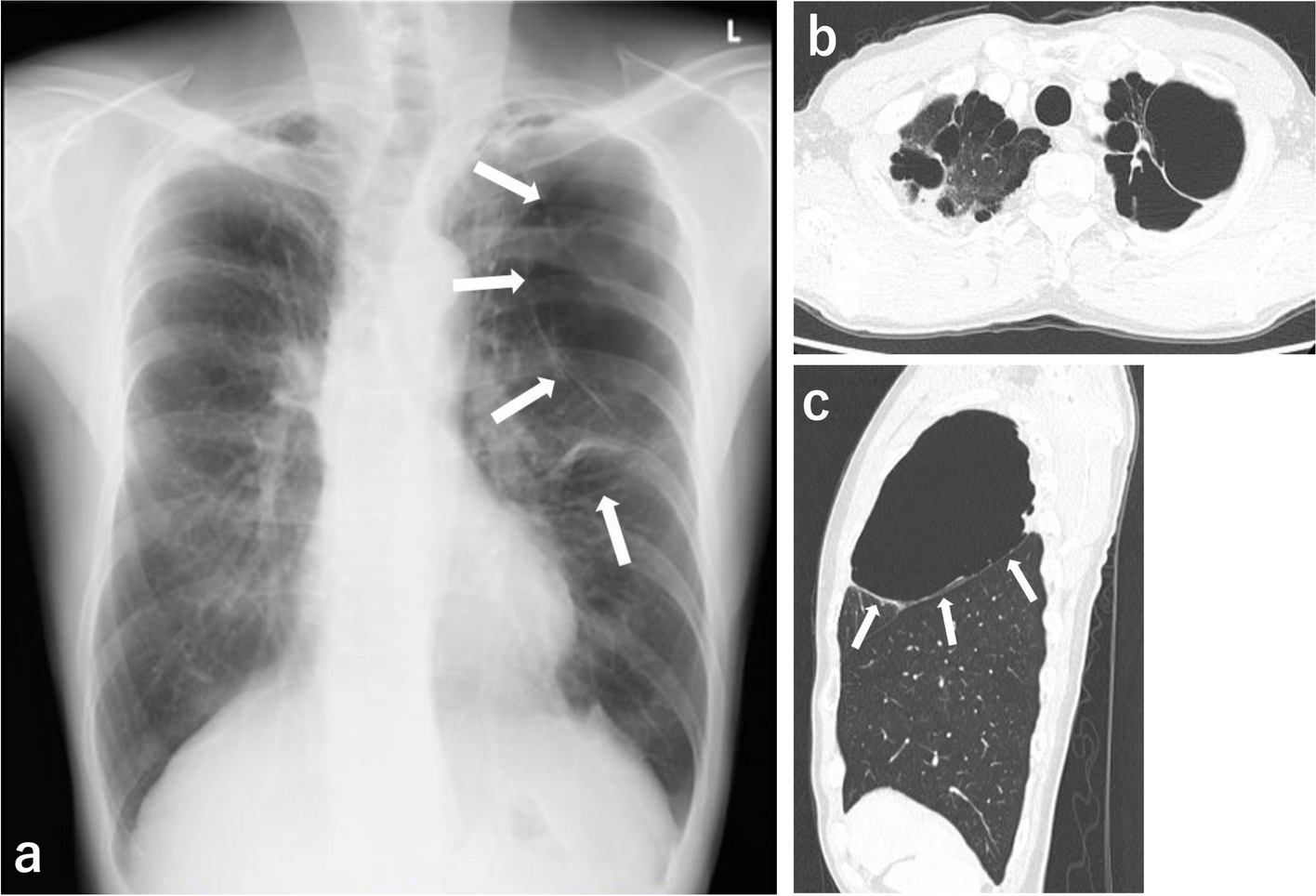 Effective use of a supraglottic airway (i-gel™) during emergence from anesthesia in a patient with multiple giant bullae