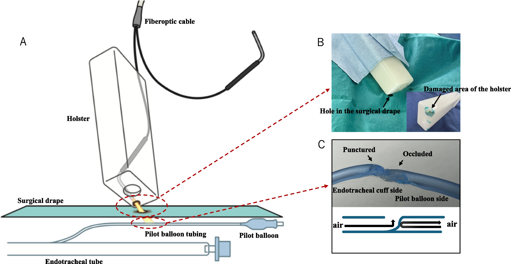 A rare case of endotracheal tube cuff leakage with no detectable decrease in cuff pressure