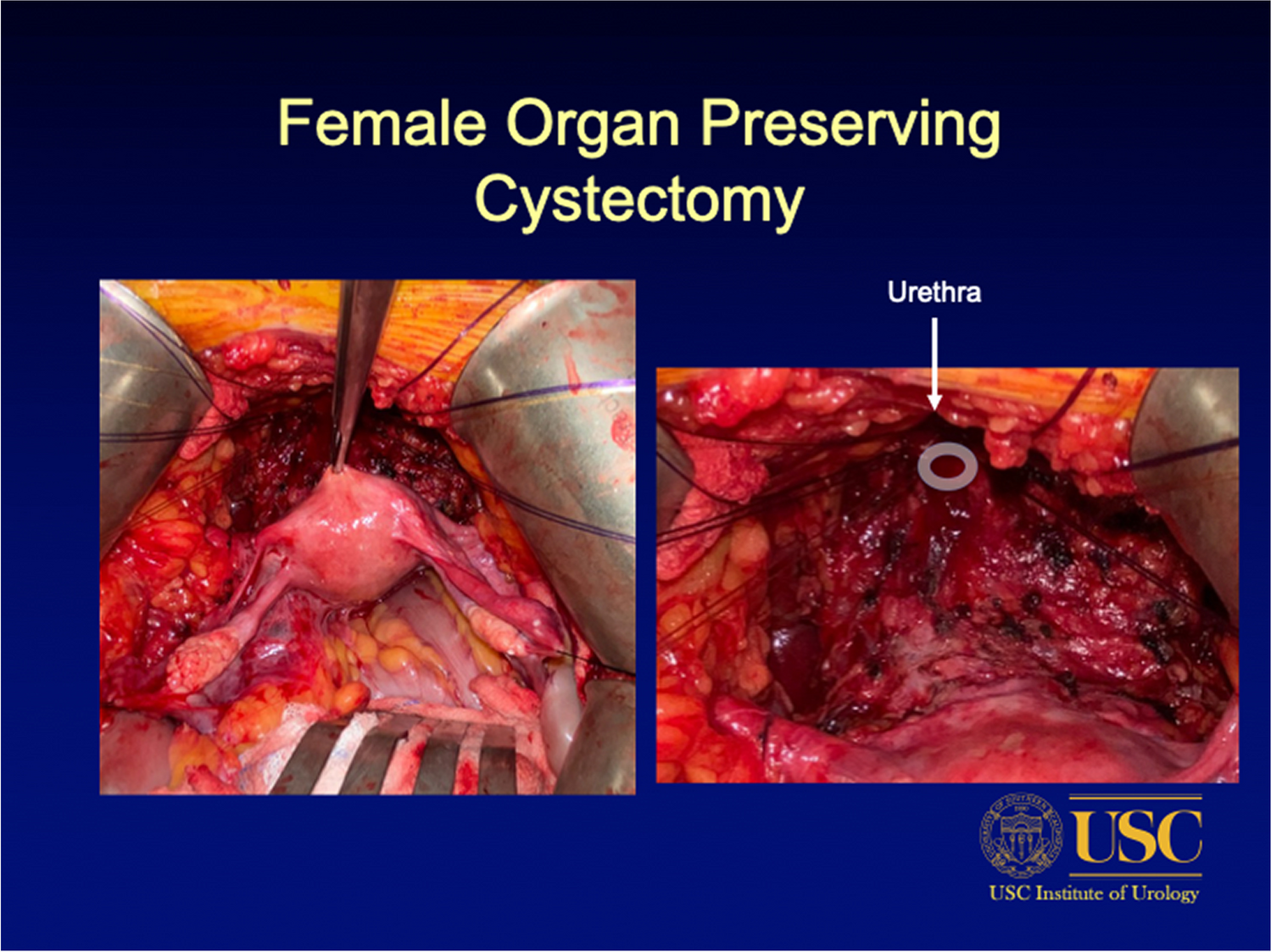 Functional Outcomes of Orthotopic Neobladder in Women