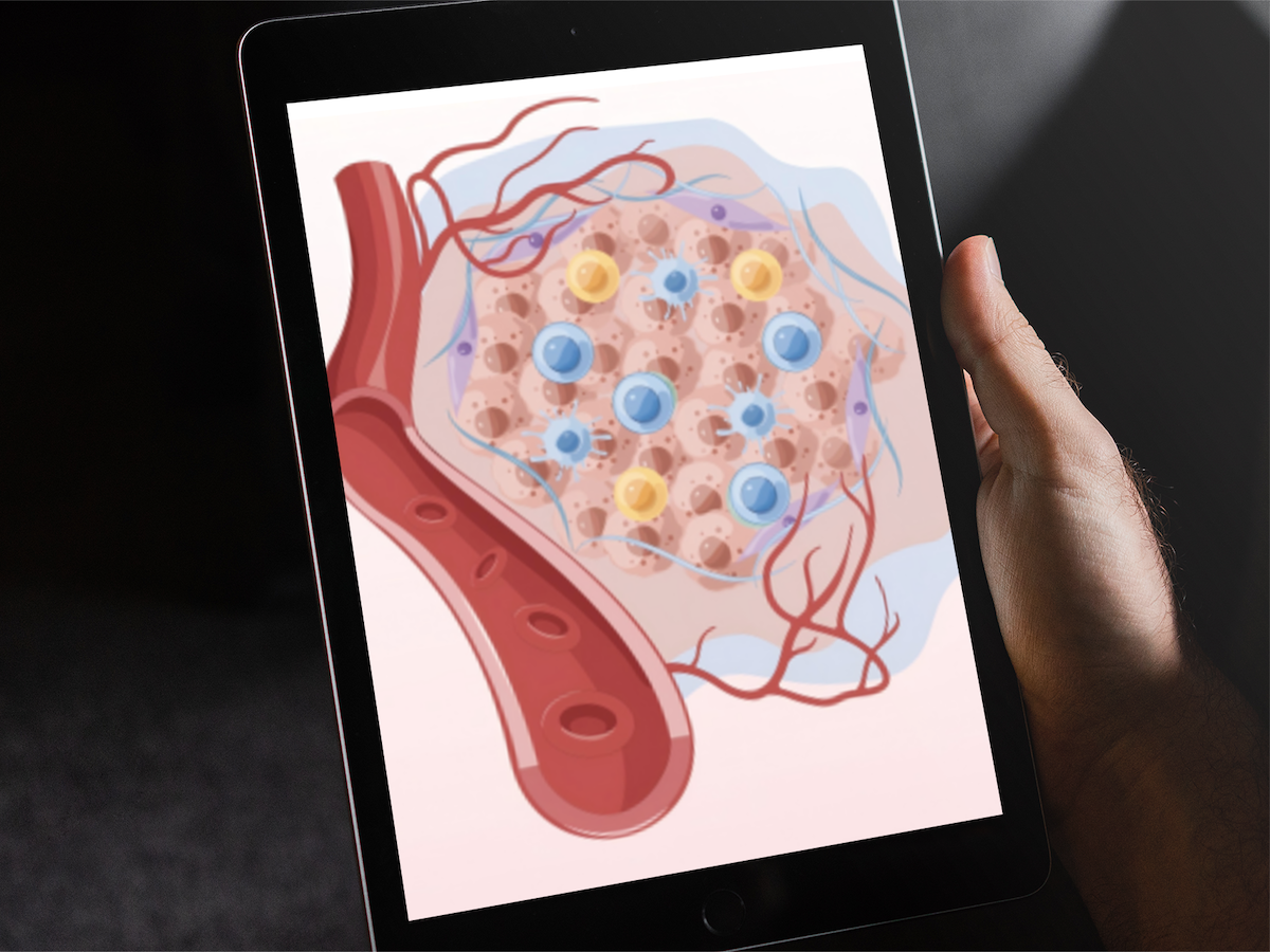 Ultrasound-Guided High-Intensity Focused Ultrasound Combined With PD-1 Blockade in Patients With Liver Metastases From Lung Cancer: Protocol for a Single-Arm Phase 2 Trial