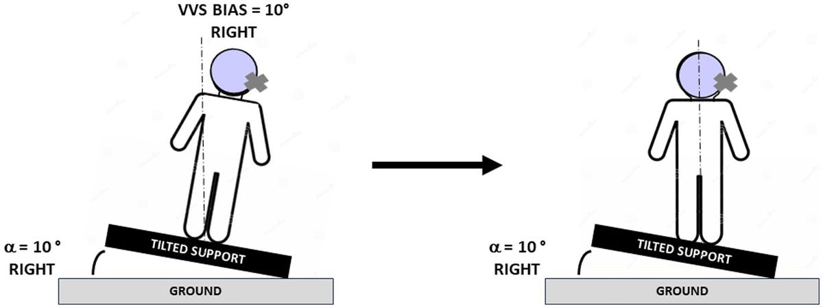 Asymmetry and rehabilitation of the subjective visual vertical in unilateral vestibular hypofunction patients