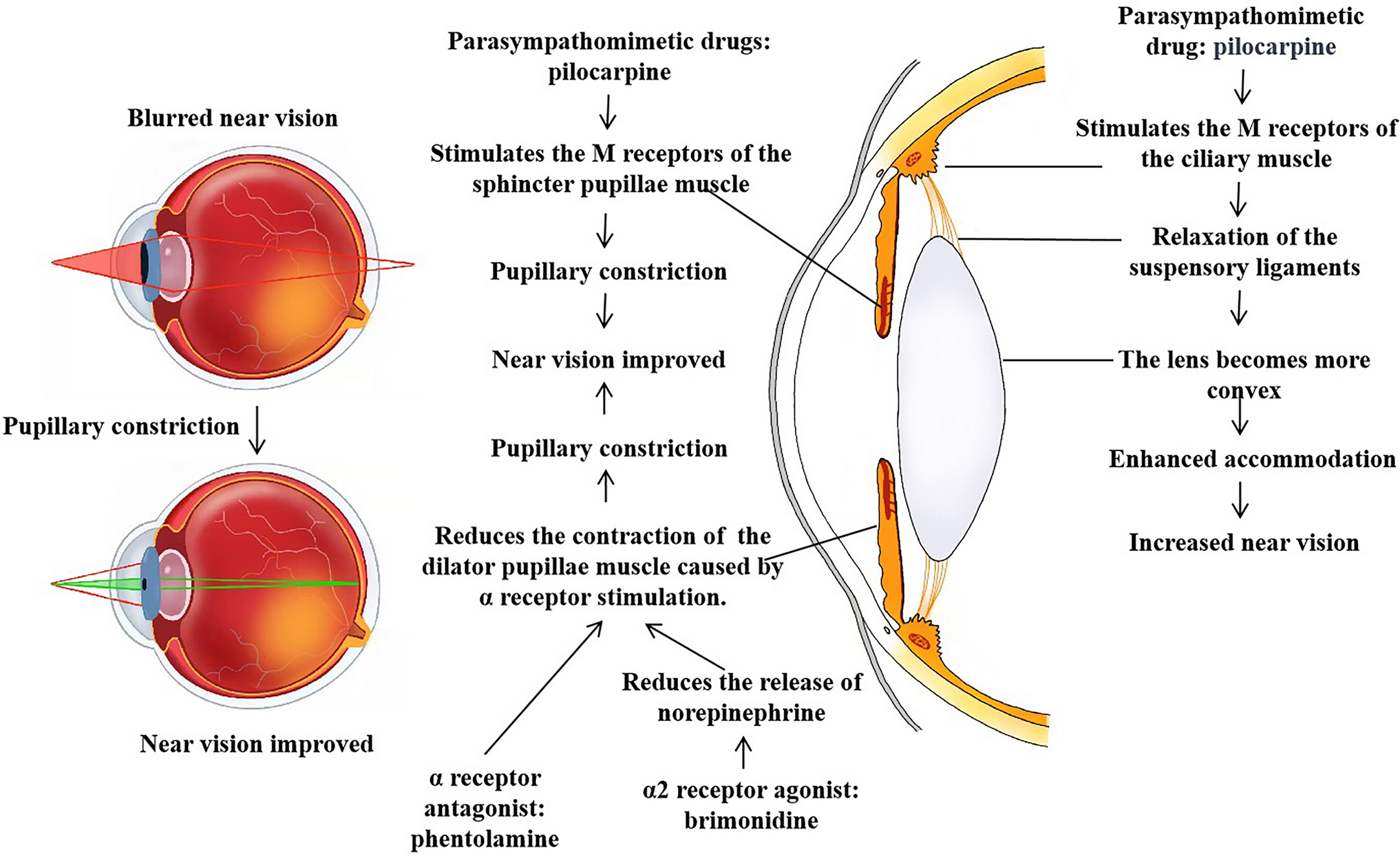 Pilocarpine in the Treatment of Presbyopia: Progress, Issues, and Future Prospects