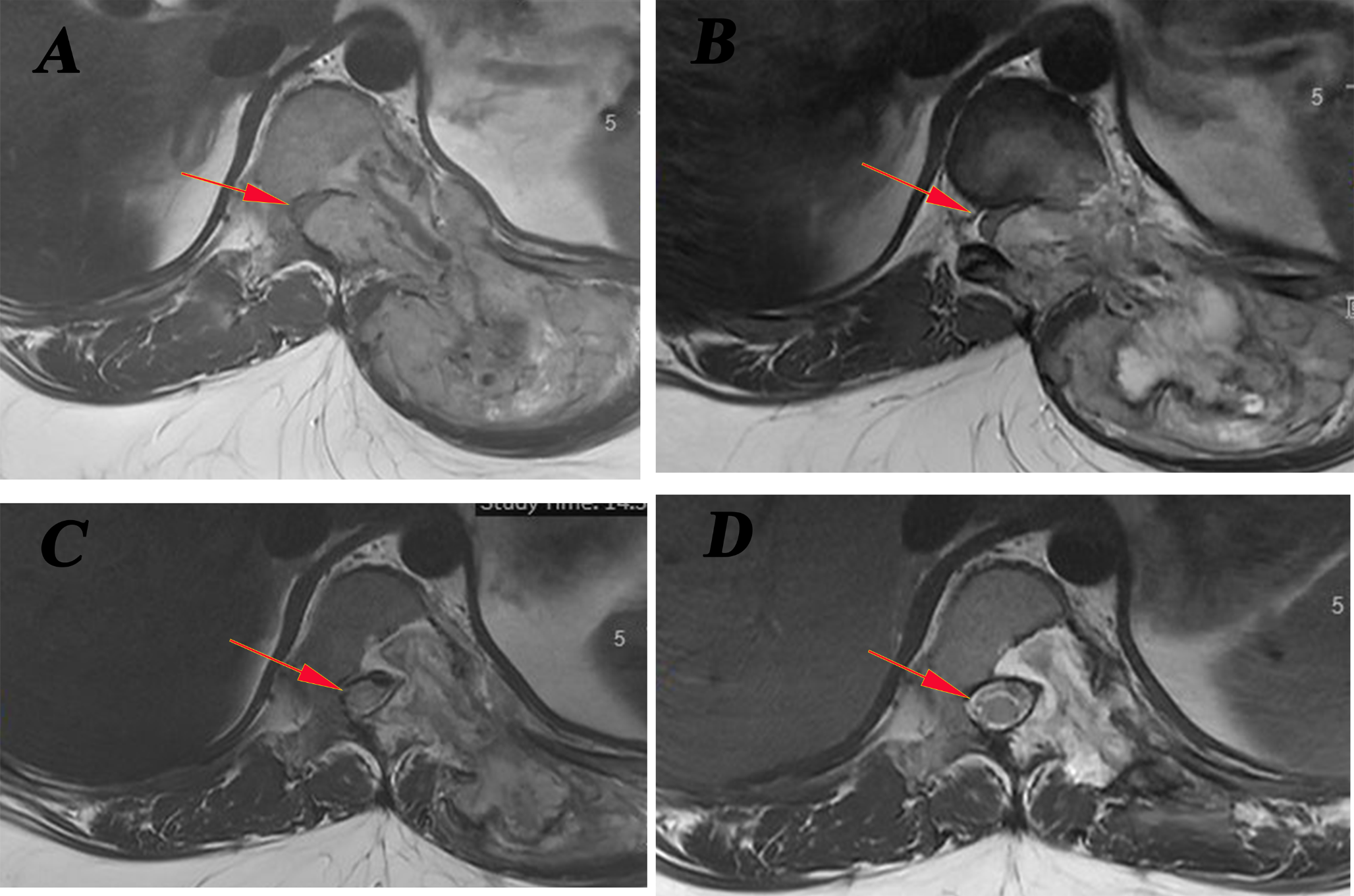 NTRK-rearranged spindle cell tumor with SPECC1L-NTRK3 fusion in the thoracic spine: a case report