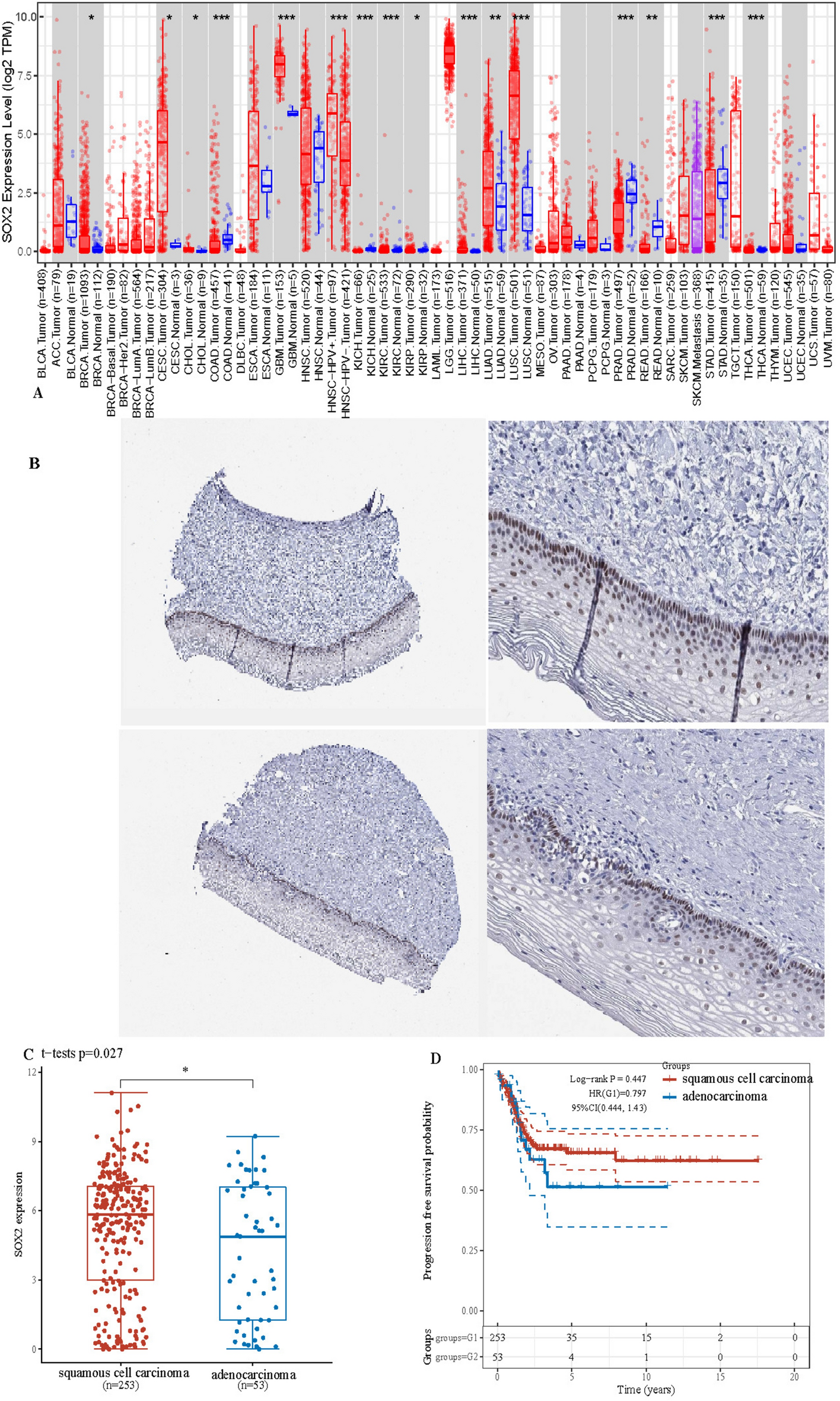 The role of the SOX2 gene in cervical cancer: focus on ferroptosis and construction of a predictive model