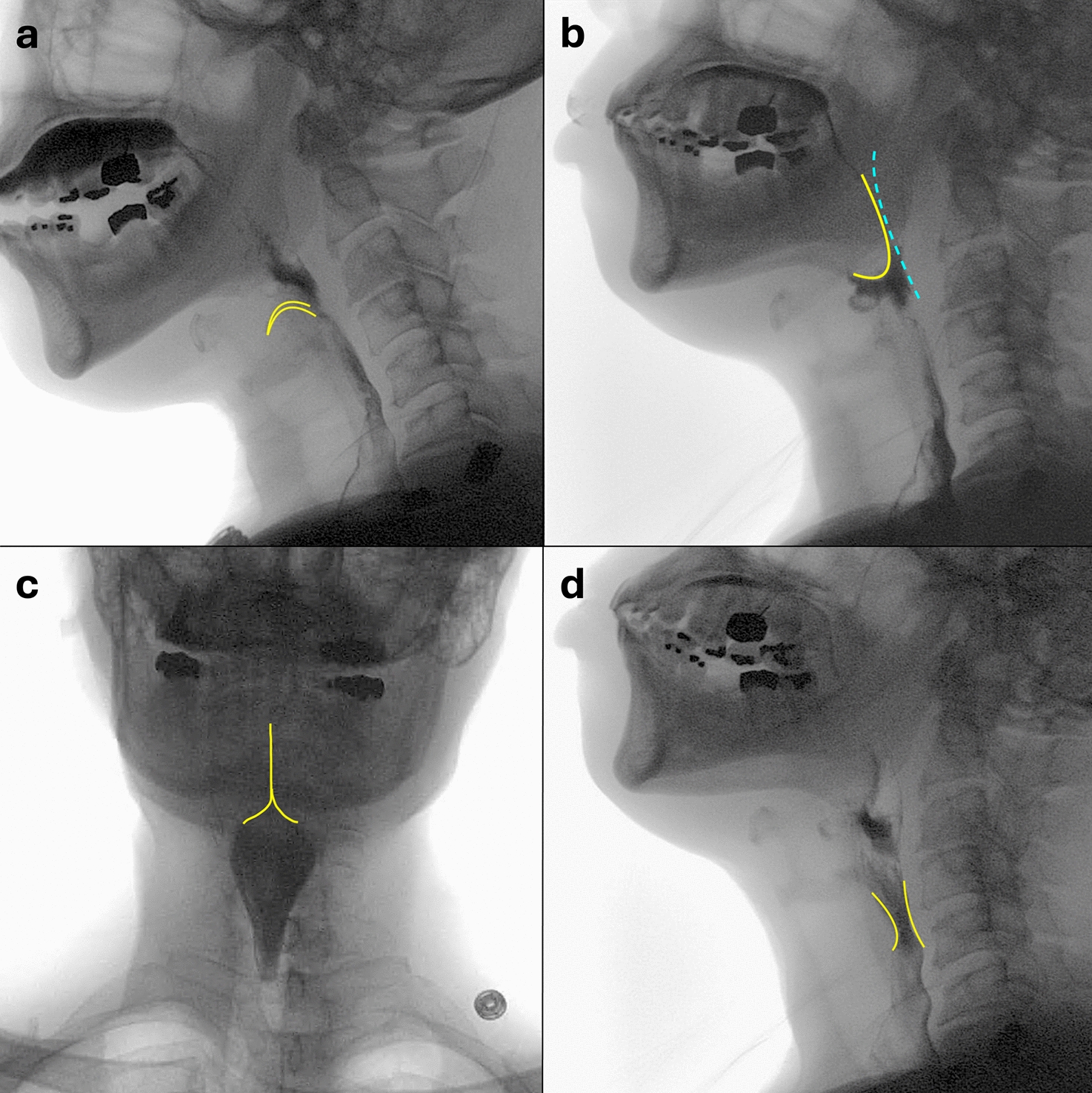 An update on pharyngeal assessment by the modified barium swallow