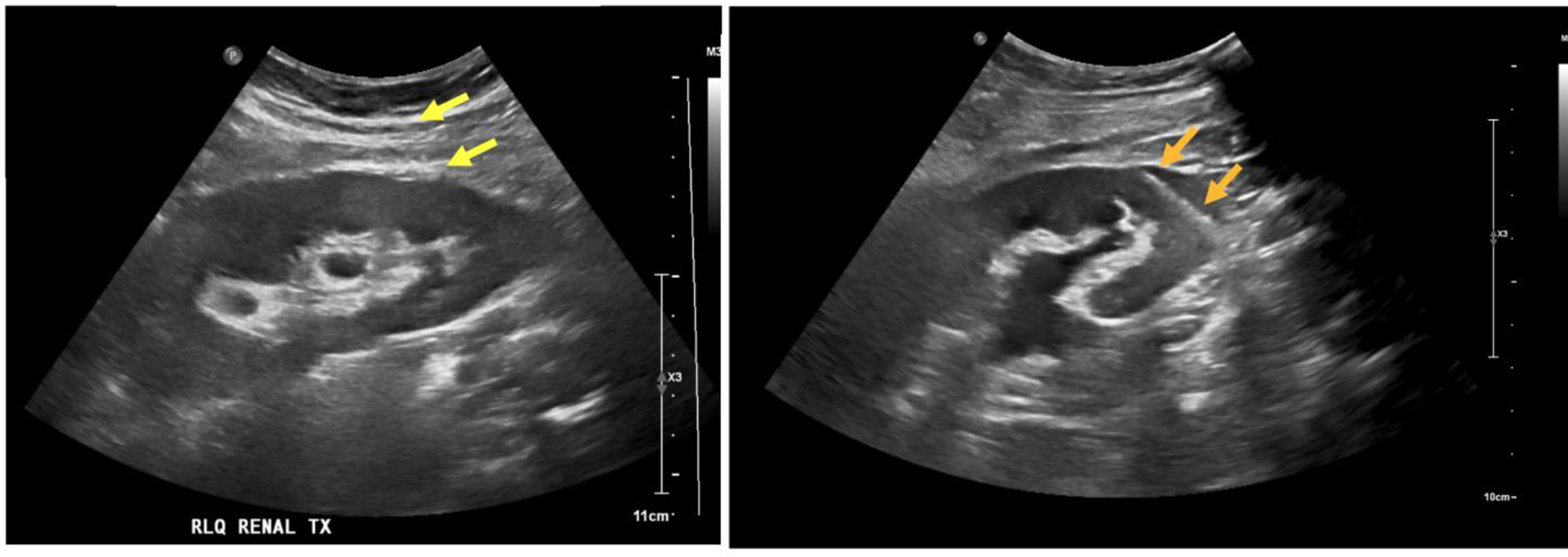 Safety and efficacy of different transplant kidney biopsy techniques: comparison of two different coaxial techniques and needle types