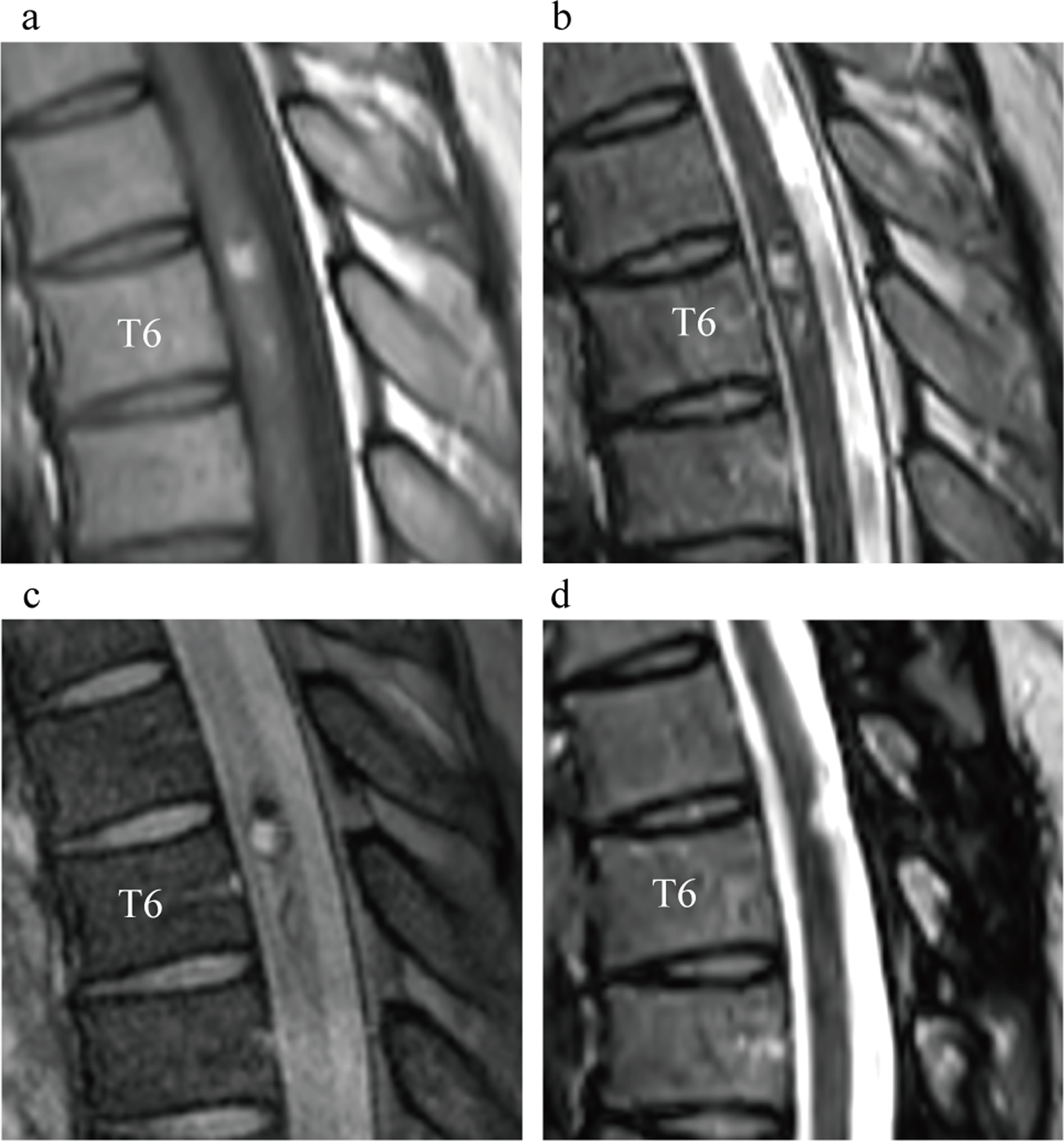 Utility of narrow band imaging in a patient with a spinal cord cavernous malformation