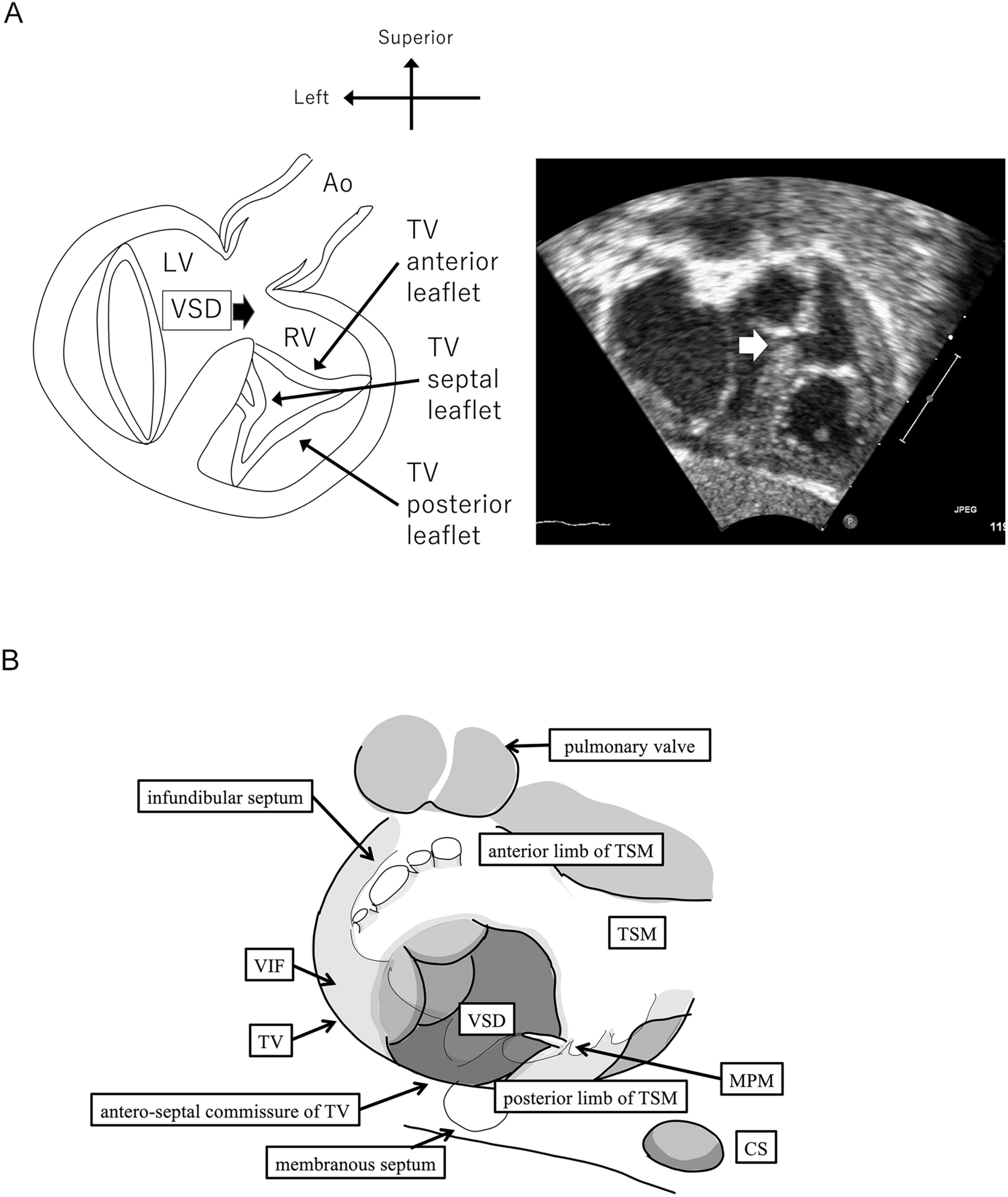 Usefulness of the “En face view” method for diagnosing perimembranous ventricular septal defects