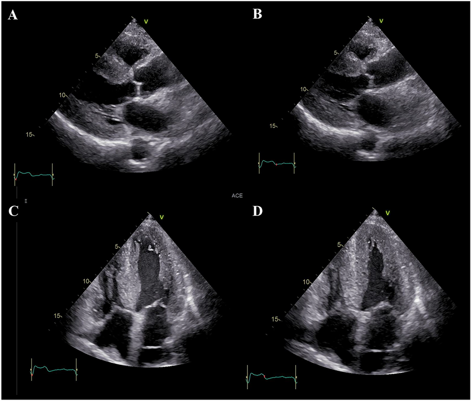 Echocardiographic findings of patients with transthyretin amyloid cardiomyopathy