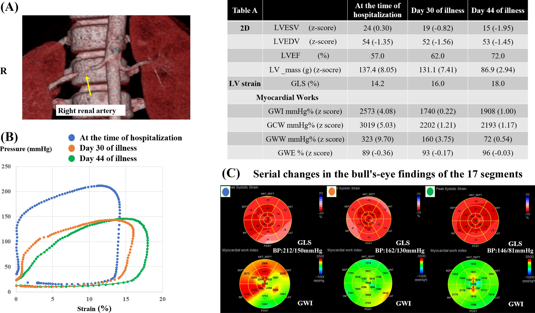 Myocardial work indices in the management of severe pediatric hypertension and left ventricular hypertrophy: a case report