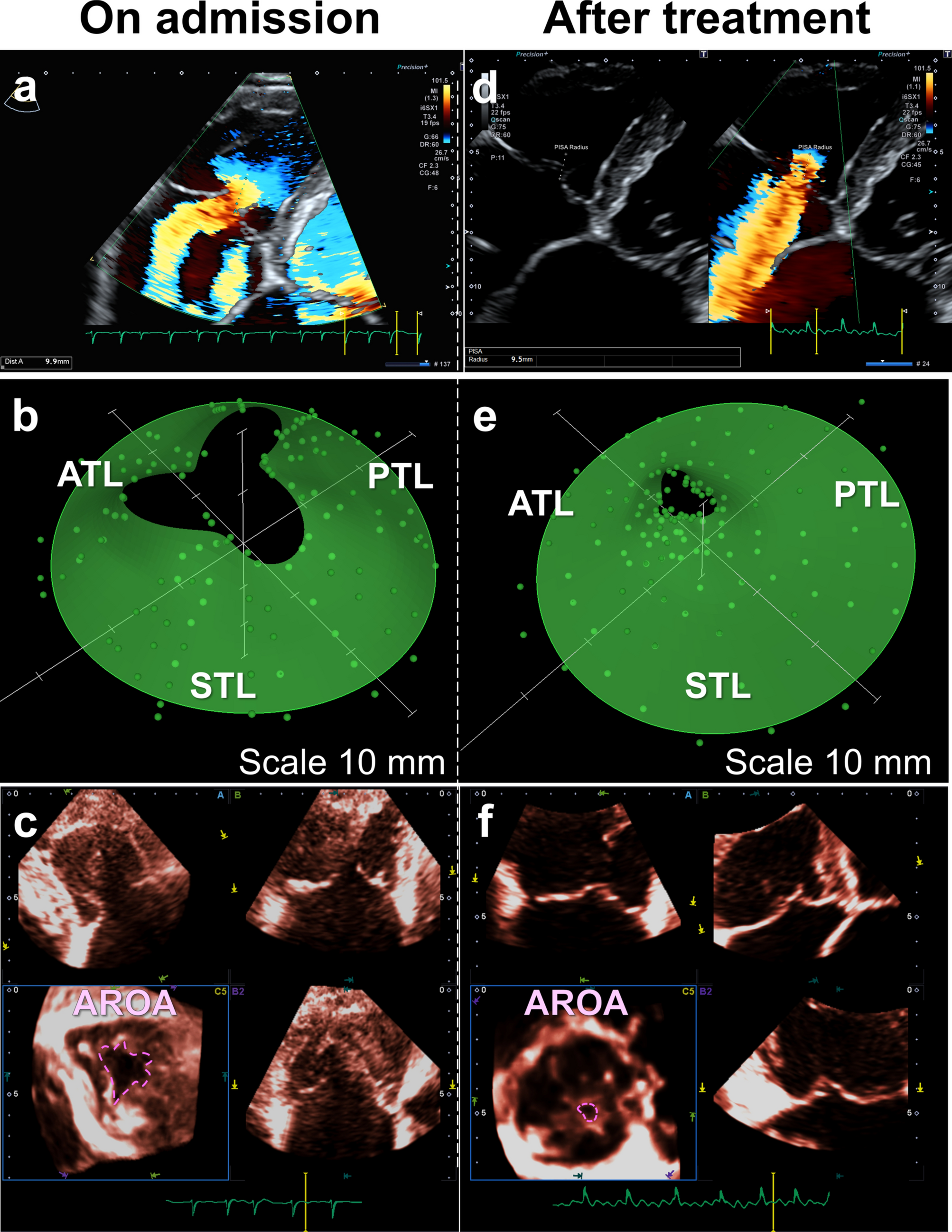 Role of anatomical regurgitant orifice area of the tricuspid valve measurements in patients with beyond severe tricuspid regurgitation