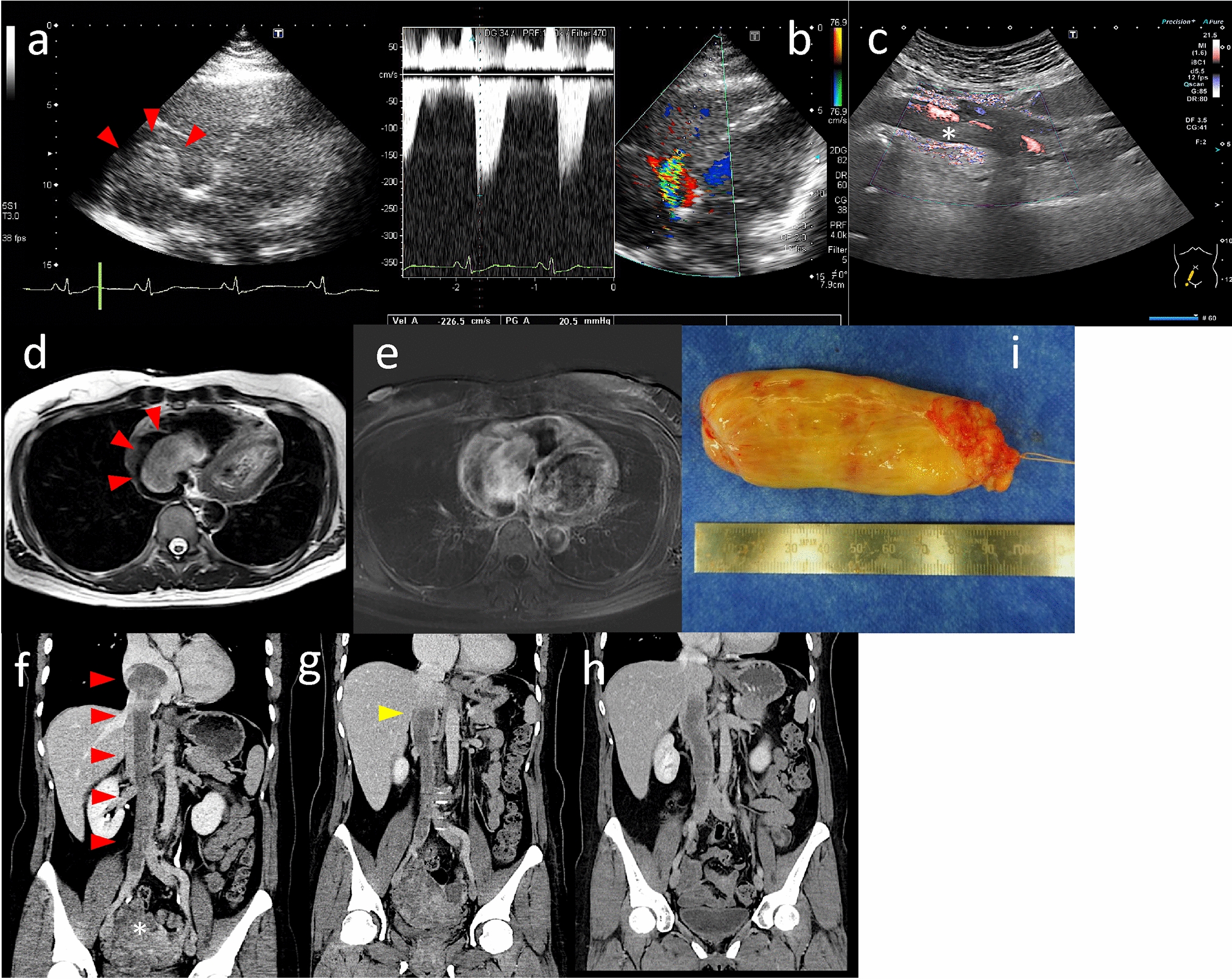 A case of intravenous leiomyomatosis with intracardiac extension