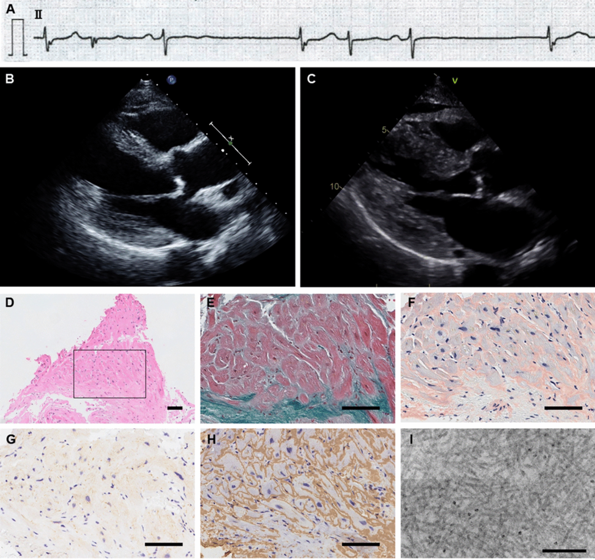 Conduction disturbance followed by progressive ventricular wall thickening as an initial manifestation of light-chain cardiac amyloidosis