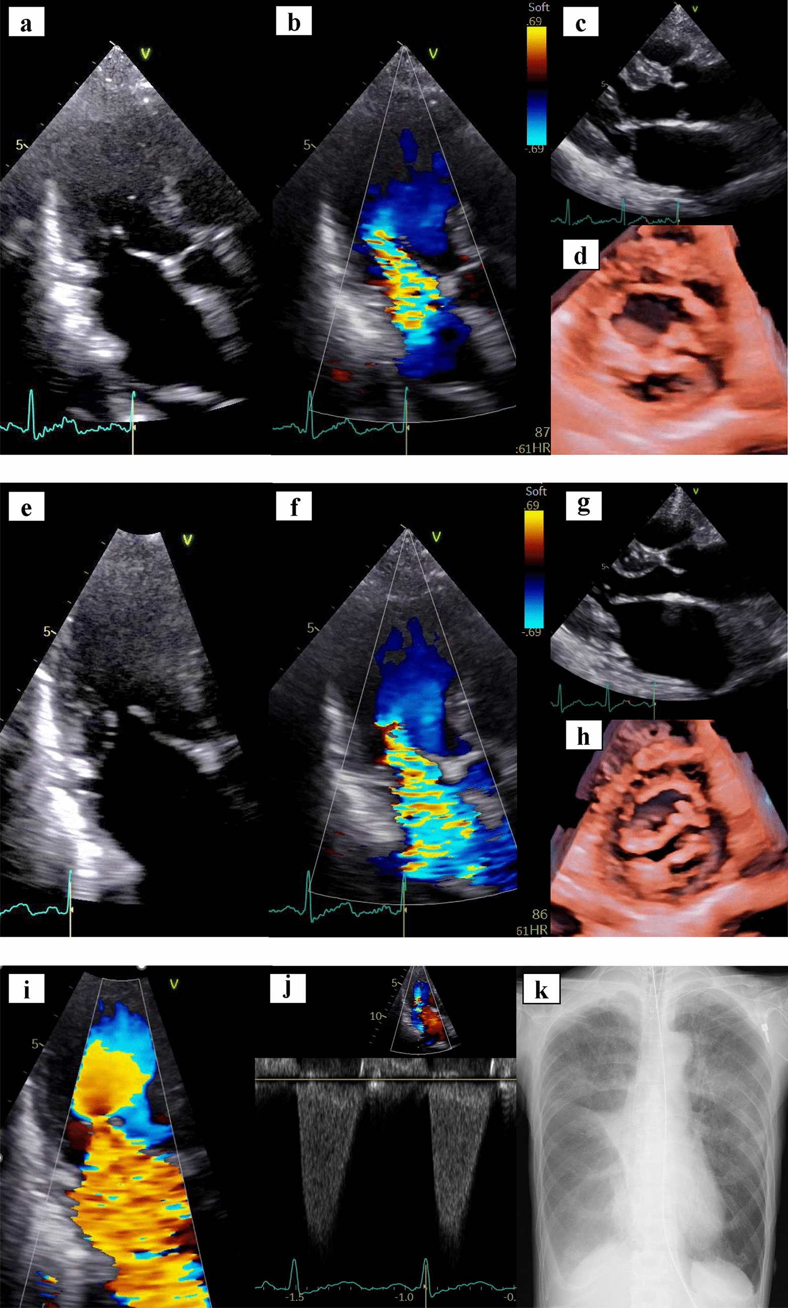 “Eclipsed mitral regurgitation” incidentally detected during routine echocardiographic examination: a case of a 70-year-old woman