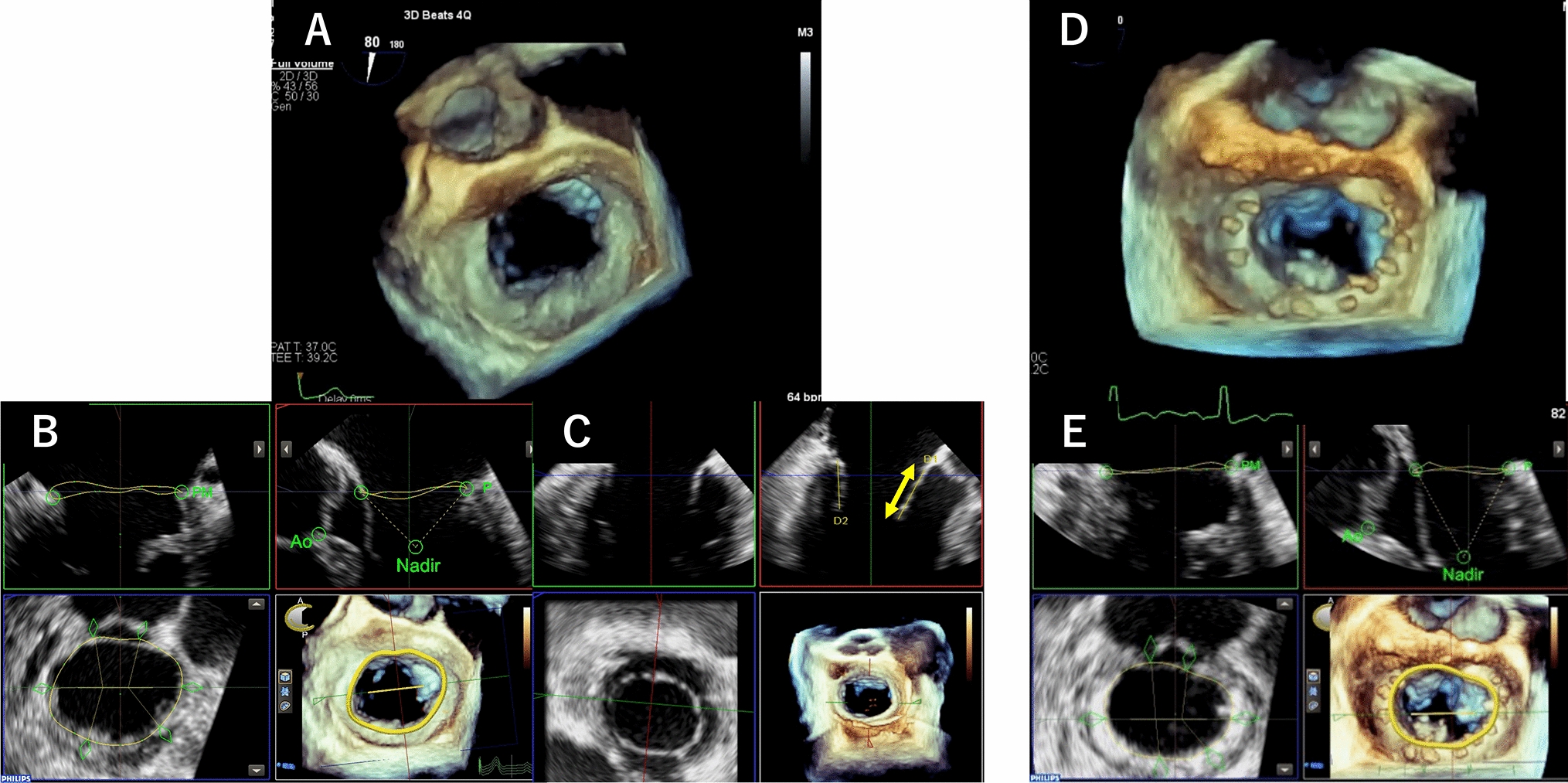 Preoperative mitral valve annulus area size is an important factor in avoiding functional mitral stenosis after mitral valve repair