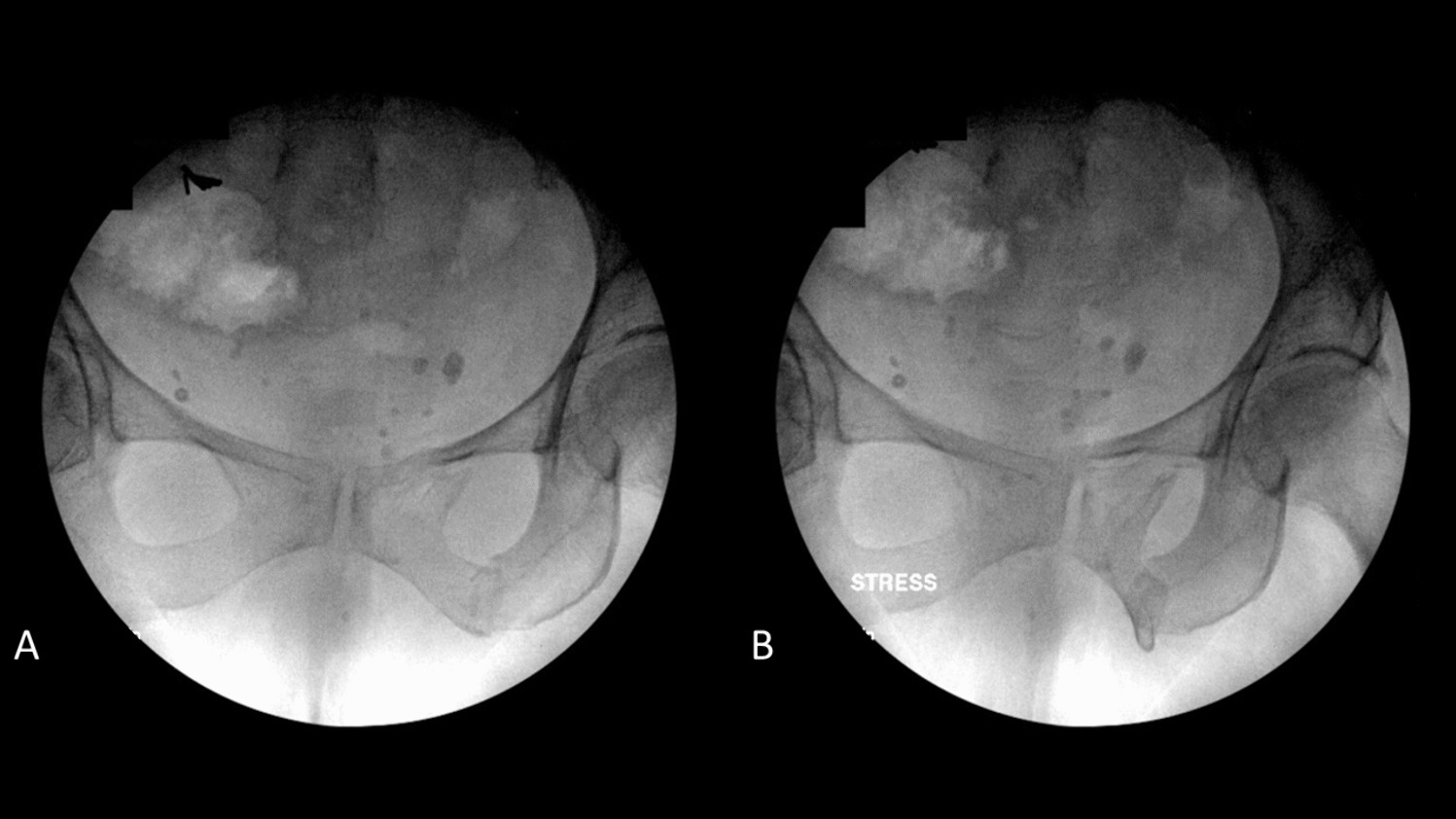 Lateral Compression Fragility Fractures of the Pelvis: Diagnosis, Classifications, and Modern Management