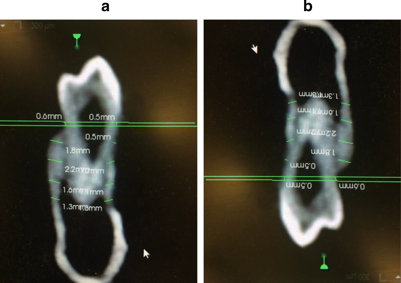 3D Analysis of Tooth Movement Using 3D Technology