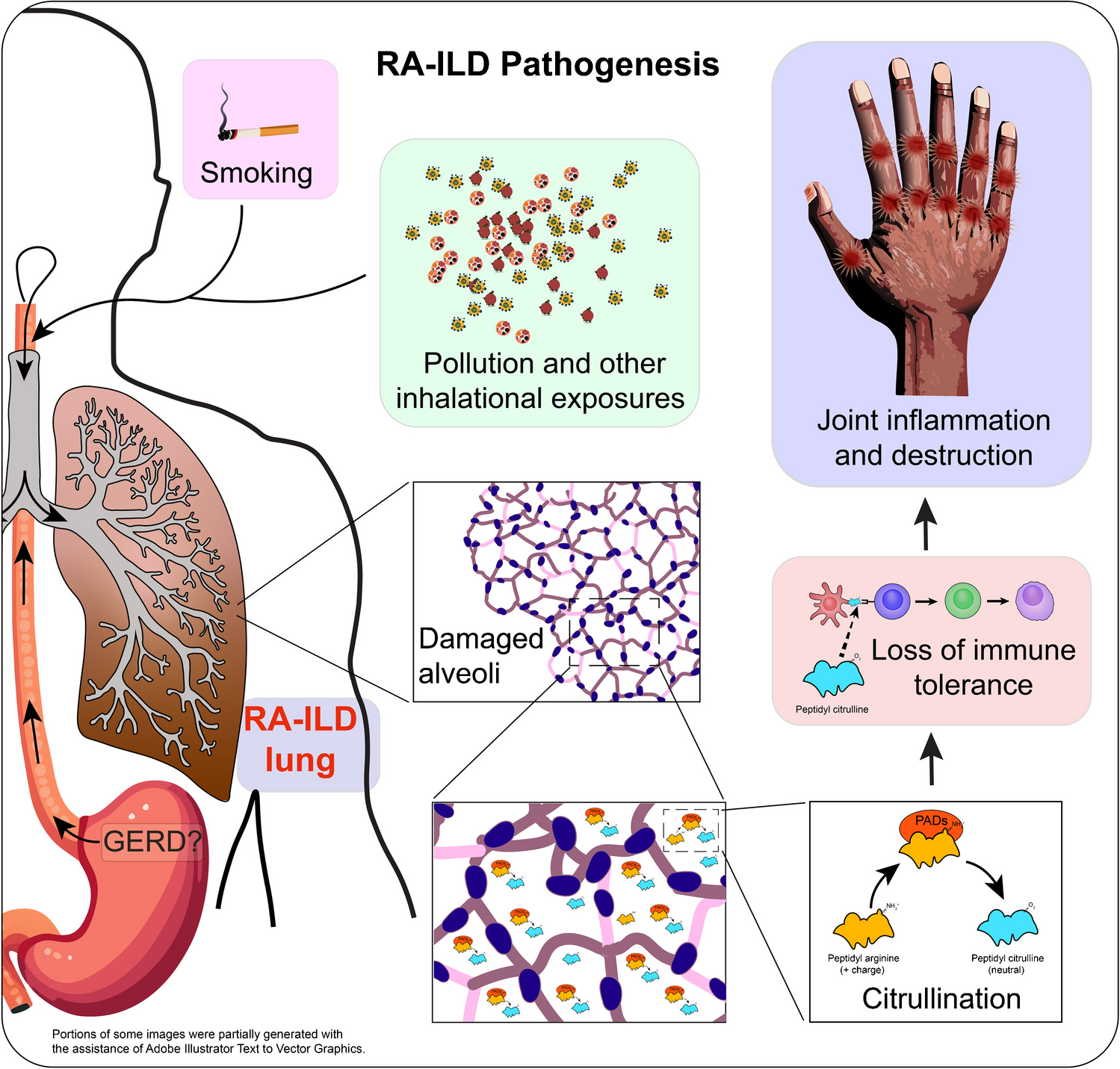 Rheumatoid Arthritis-Associated Interstitial Lung Disease (RA-ILD): Update on Prevalence, Risk Factors, Pathogenesis, and Therapy