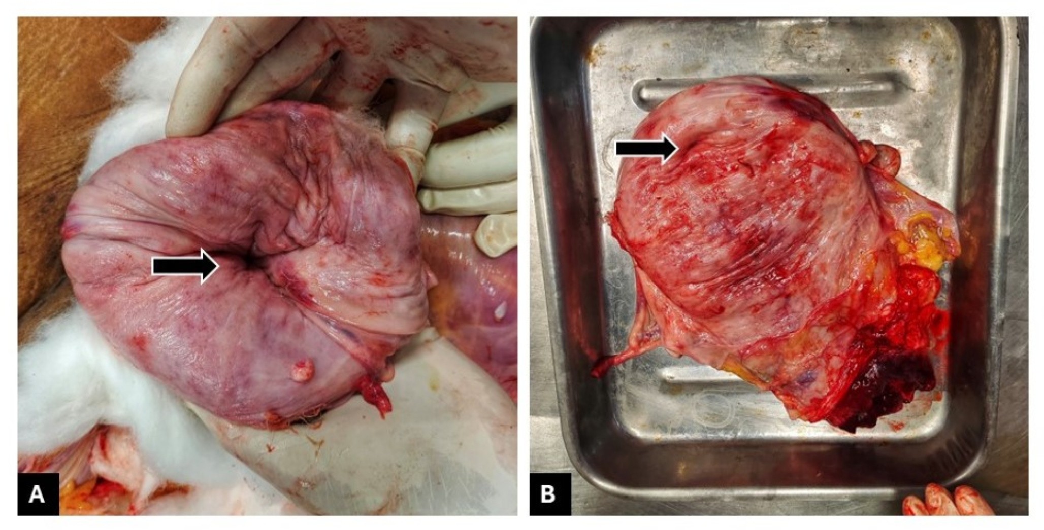 Fatal acute uterine inversion post-vaginal delivery: an autopsy-based case report