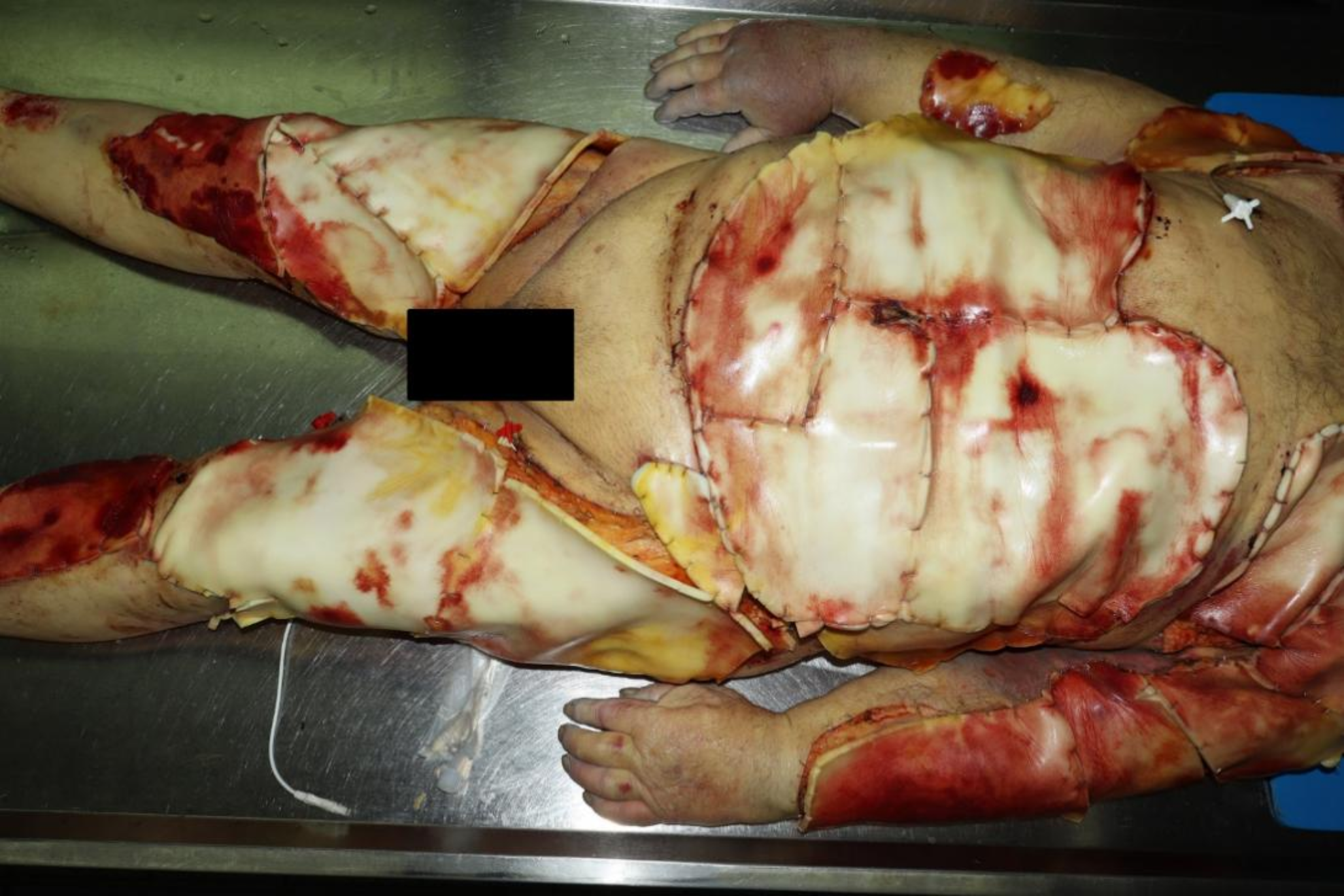 Lack of gastric emptying at autopsy eleven days after heat trauma in the sauna– a forensic autopsy case report