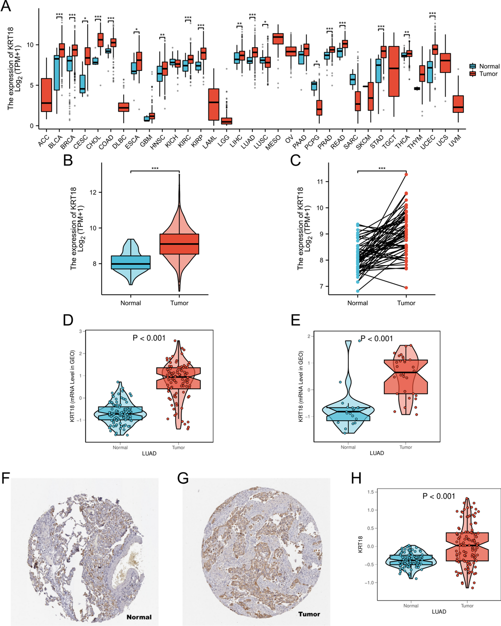 The role of KRT18 in lung adenocarcinoma development: integrative bioinformatics and experimental validation