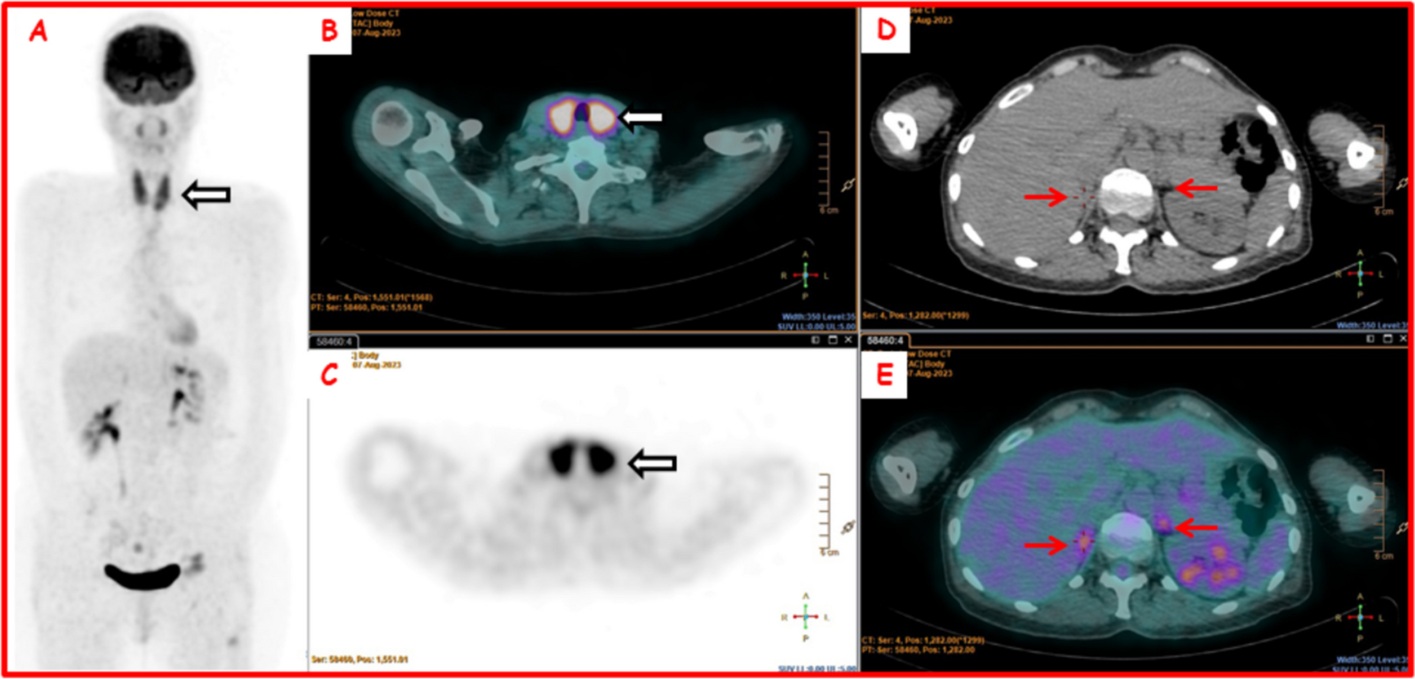 Challenges and pitfalls in the management of endocrine toxicities from immune checkpoint inhibitors: a case presentation of synchronous thyrotoxicosis and primary adrenal insufficiency in a melanoma patient