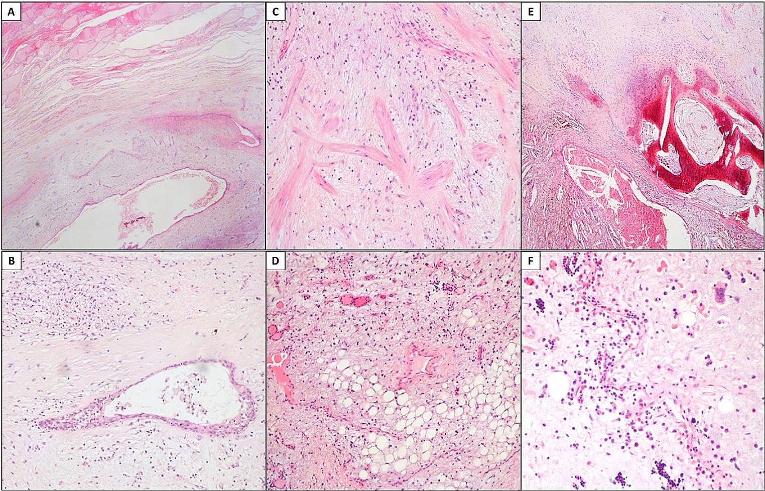 Choristoma: a very rare cause of thyroid nodule. Case report and literature review