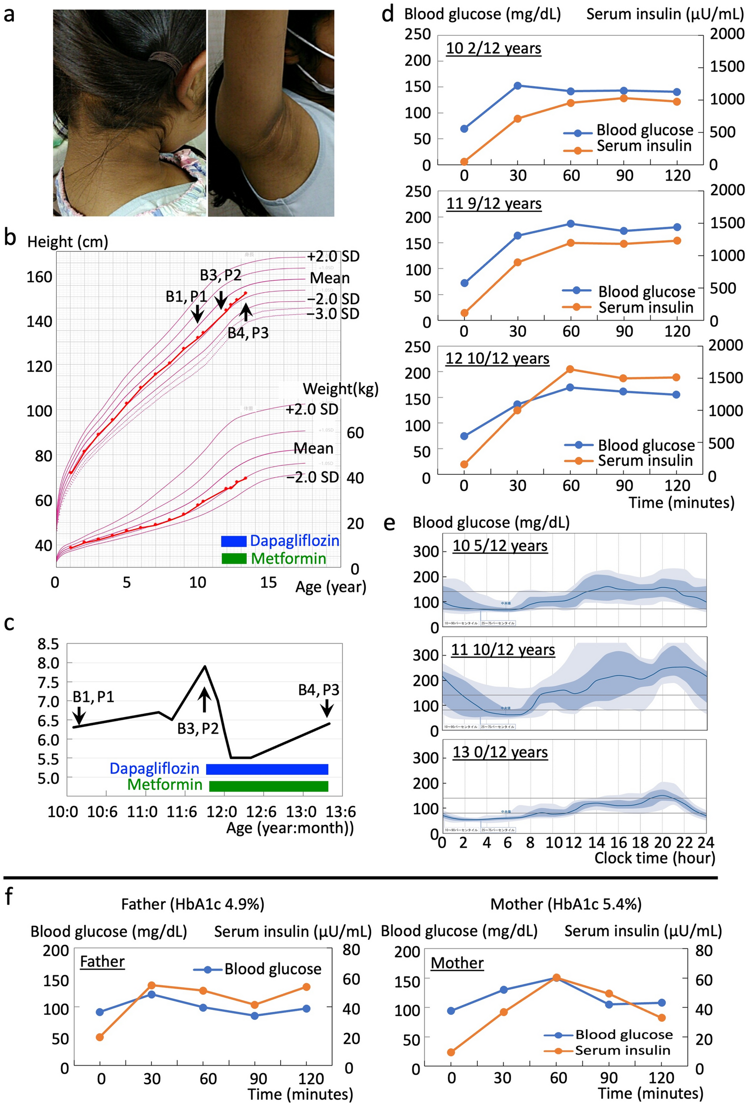 Insulin resistant diabetes mellitus in a girl with mild Rabson-Mendenhall syndrome: efficacy of sodium glucose co-transporter 2 inhibitor