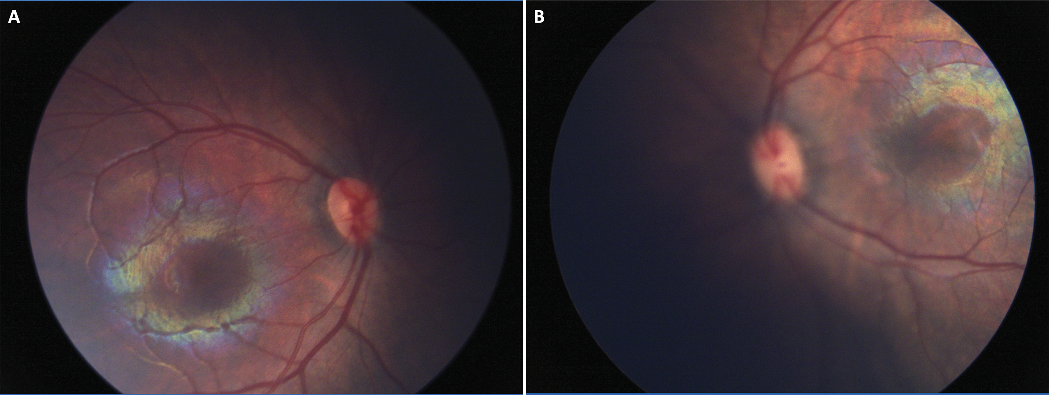 Bilateral familial retinoblastoma diagnosed via optical coherence tomography following a normal funduscopic exam