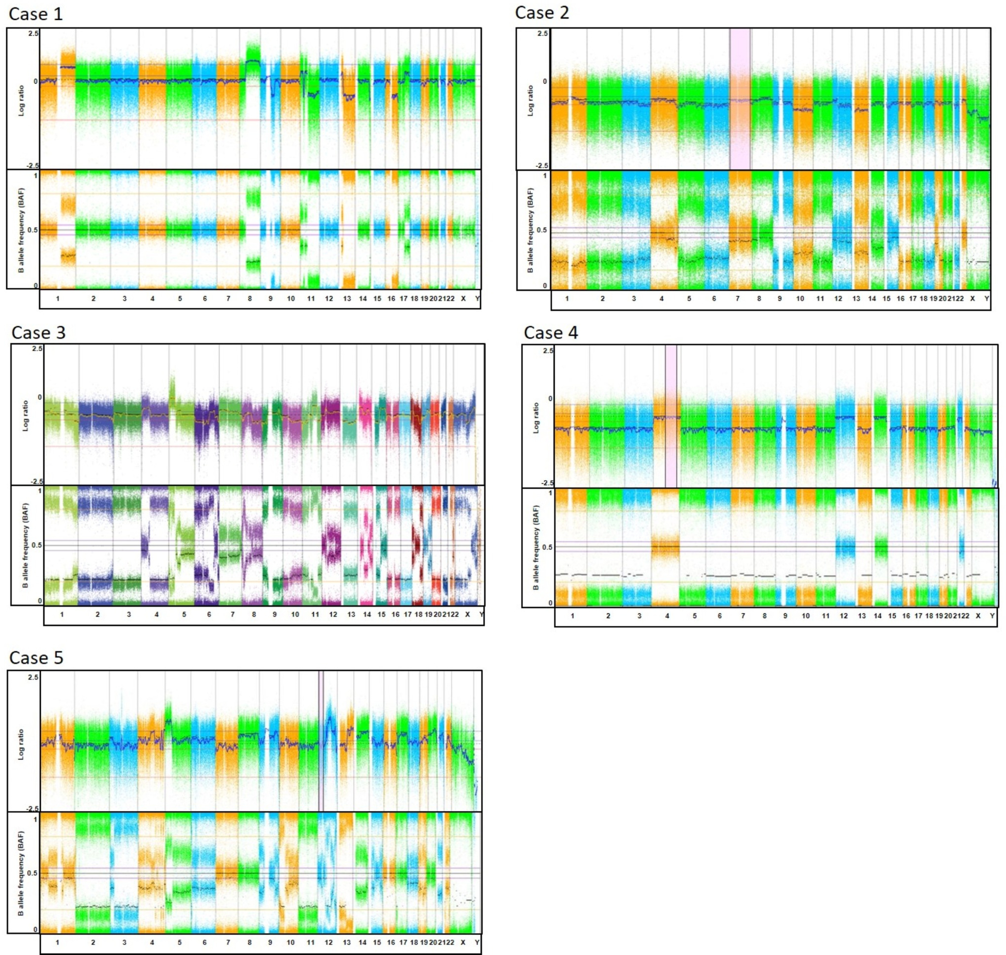 Sarcomas arising in MEN1 patients: demonstrating LOH of the MEN1 locus and loss of menin expression