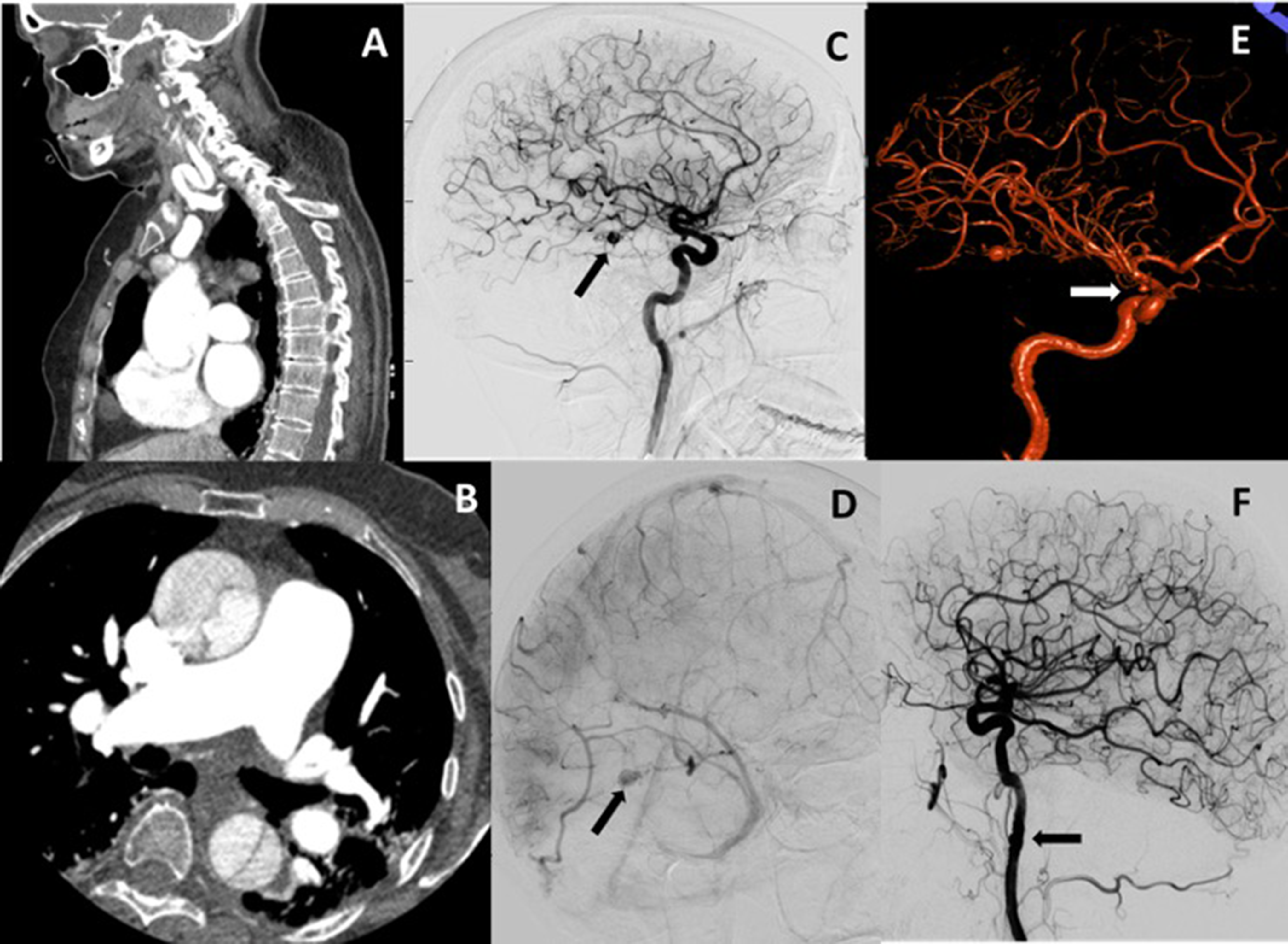 Overlap syndrome of hereditary hemorrhagic telangiectasia and juvenile polyposis syndrome: ten years follow-up-case series and review of literature