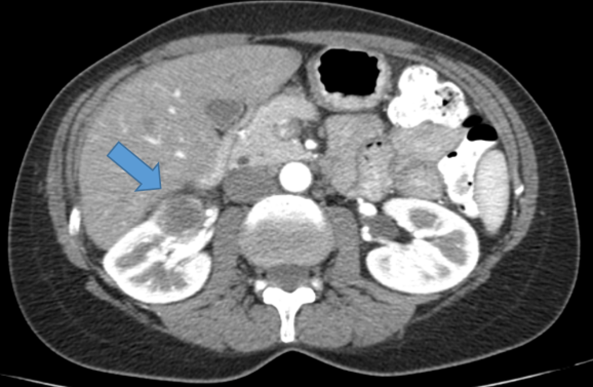 Metastatic disease after removal of a renal cell carcinoma smaller than 3 cm in a patient with Birt-Hogg-Dubé syndrome, a case report