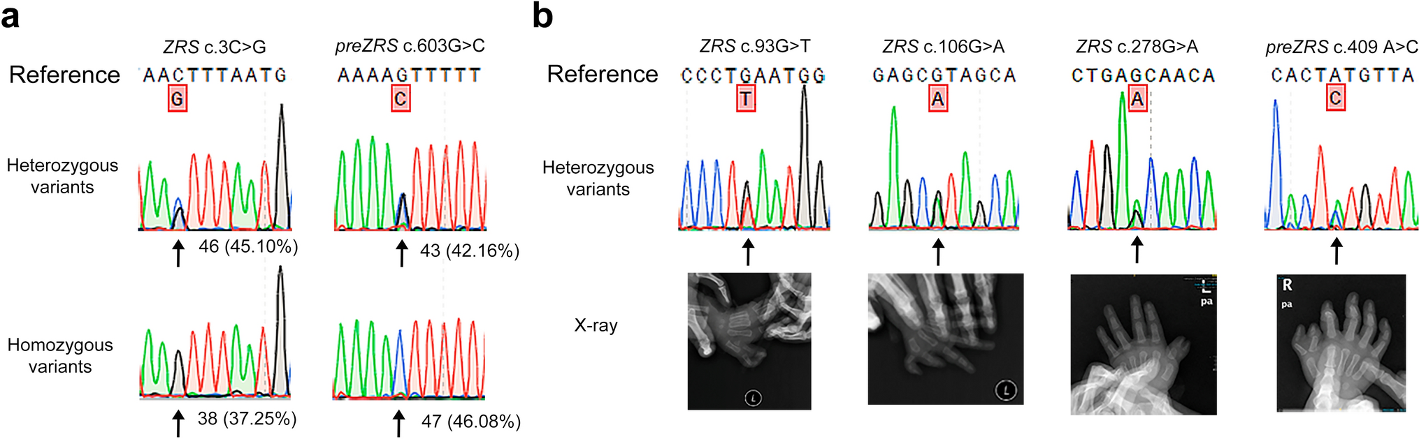 Genetic analysis of preaxial polydactyly: identification of novel variants and the role of ZRS duplications in a Chinese cohort of 102 cases