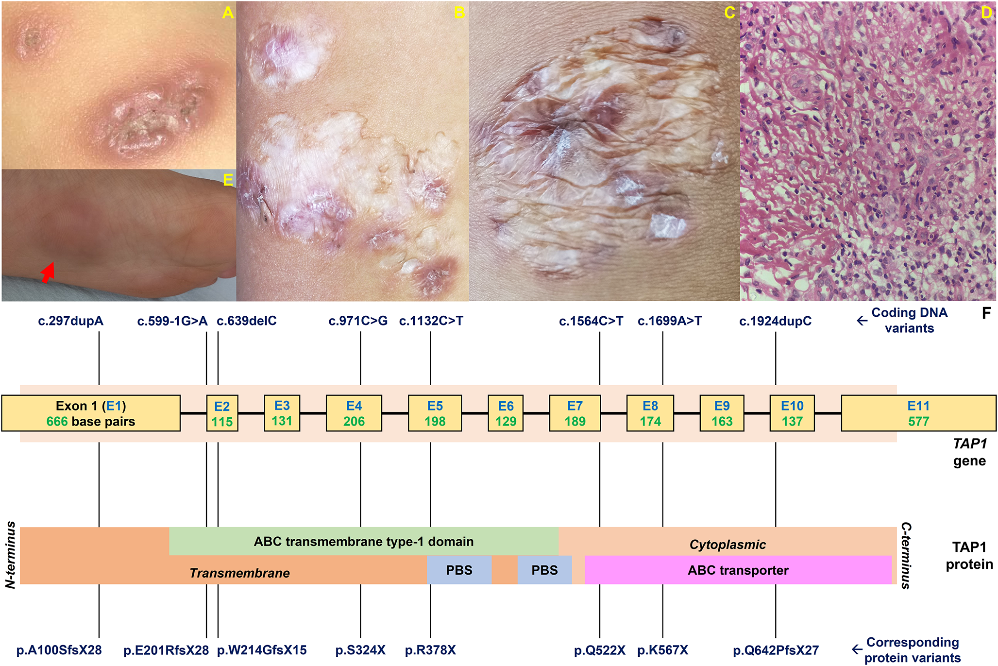 Novel Inherited N-terminus TAP1 Variants and Severe Clinical Manifestations– Are Genotype-Phenotype Correlations Emerging?