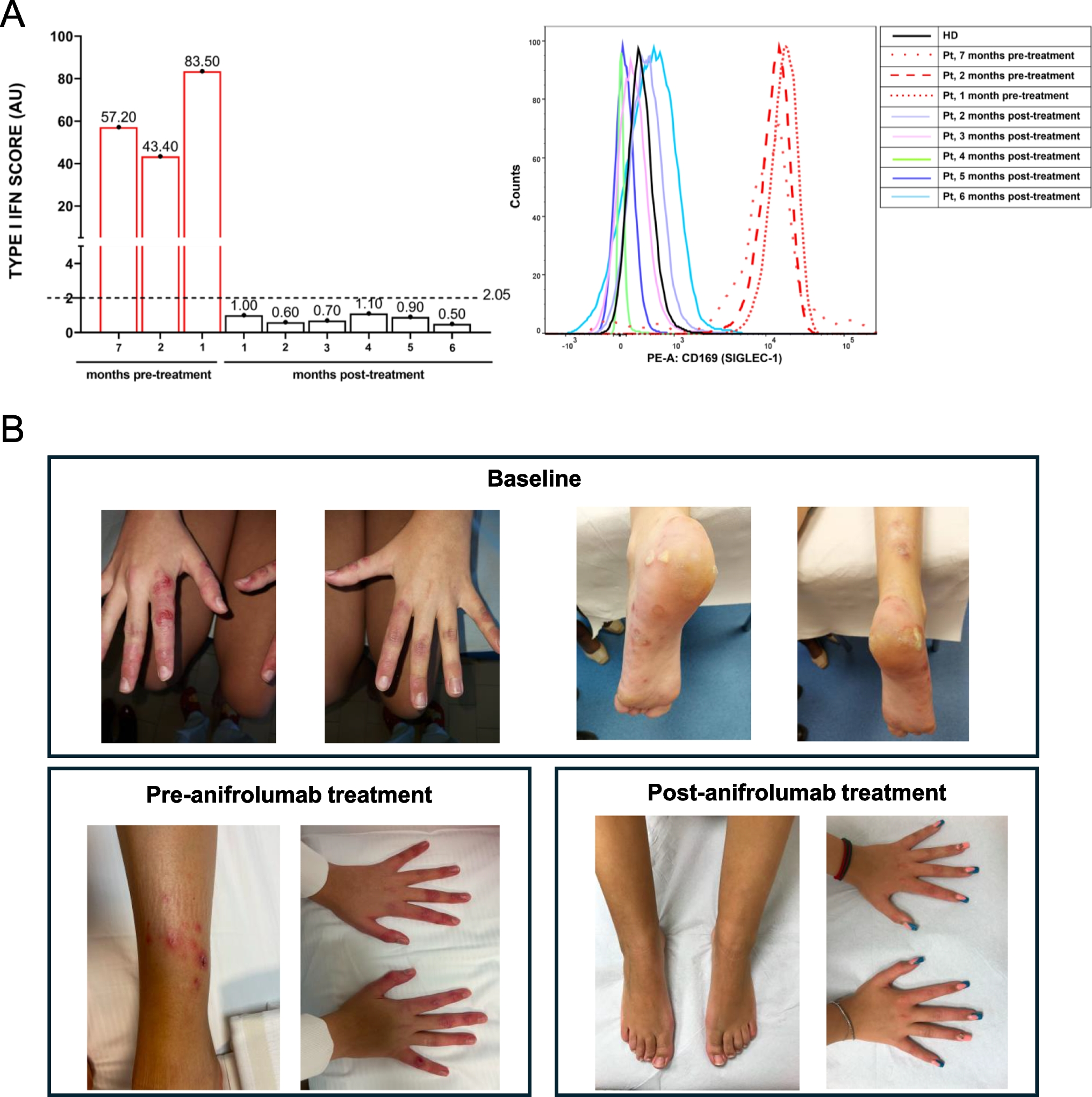 Anifrolumab in Monogenic Lupus caused by TREX1 Mutation