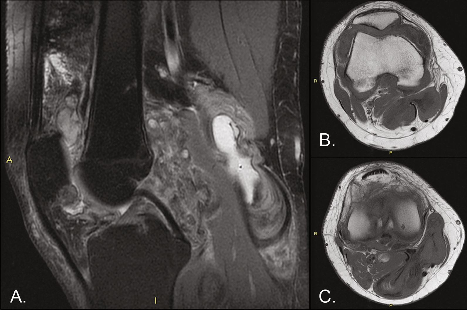 Pexidartinib Upfront in a Case of Tenosynovial Giant Cell Tumor: Proof of Concept for a Treatment Paradigm Shift