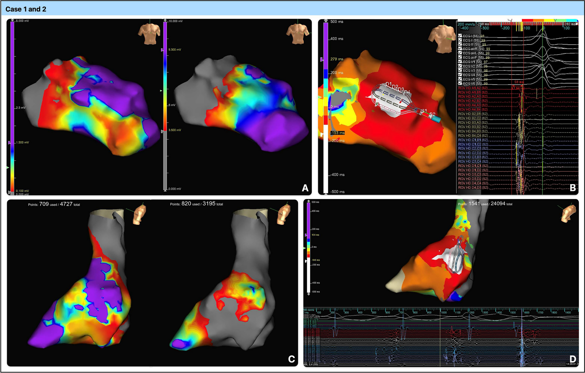 Understanding the Significance and Approach to Ventricular Tachycardia Ablation of Scar-related Border Zones