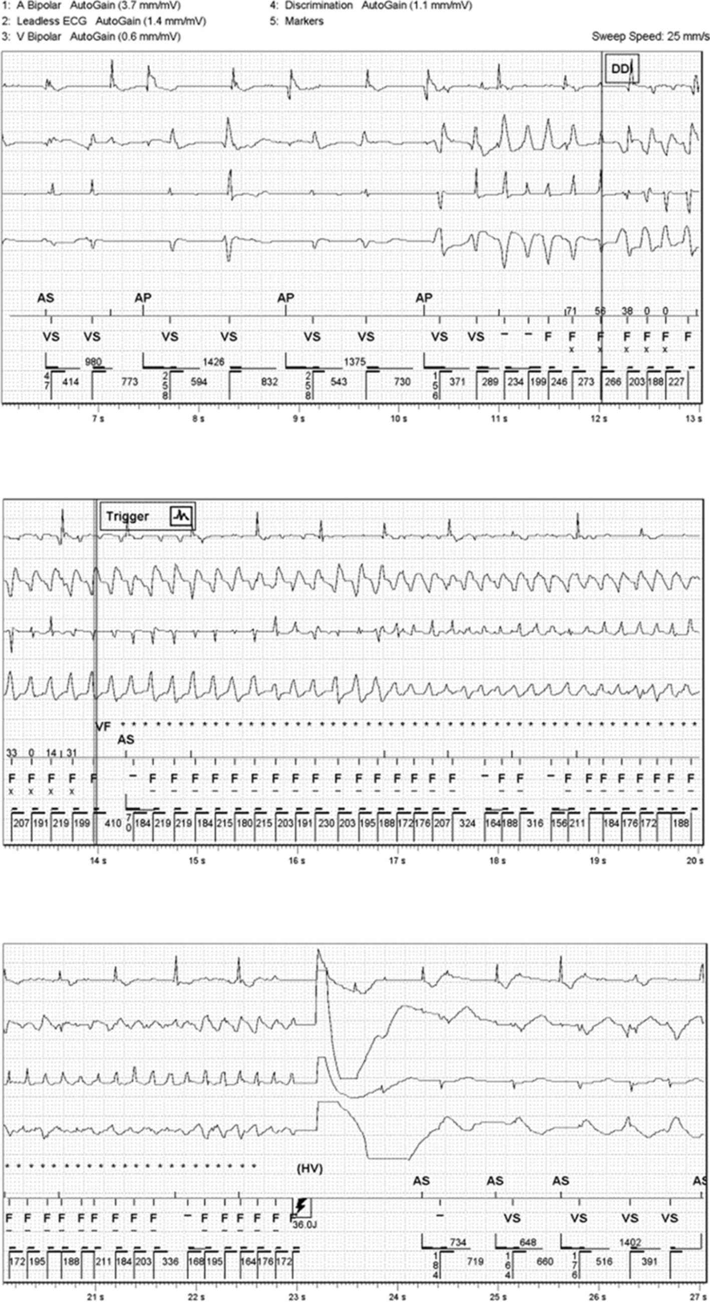 Mitral Valve Dysplasia: An Updated Review