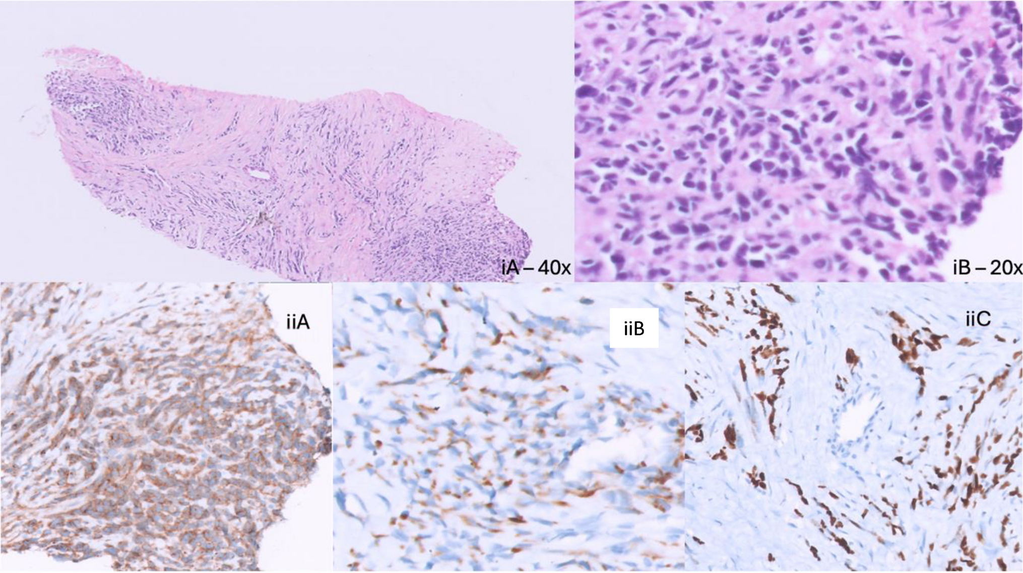 Primary Liver Rhabdomyosarcoma with Burnt-out Paravertebral Disease