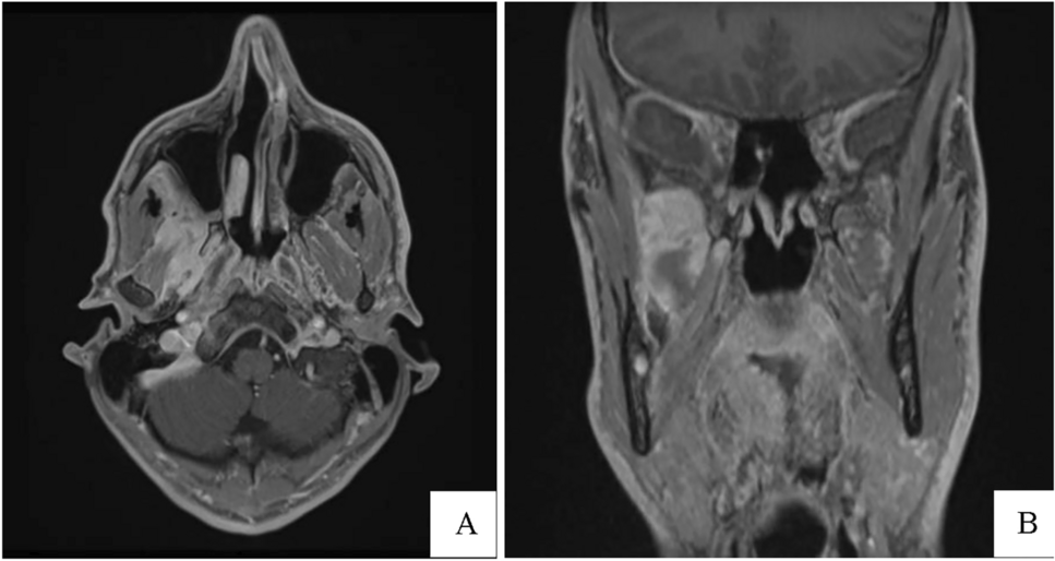 Are there atypical sites of IgG4 related disease in head and neck region? Personal experience and literature review