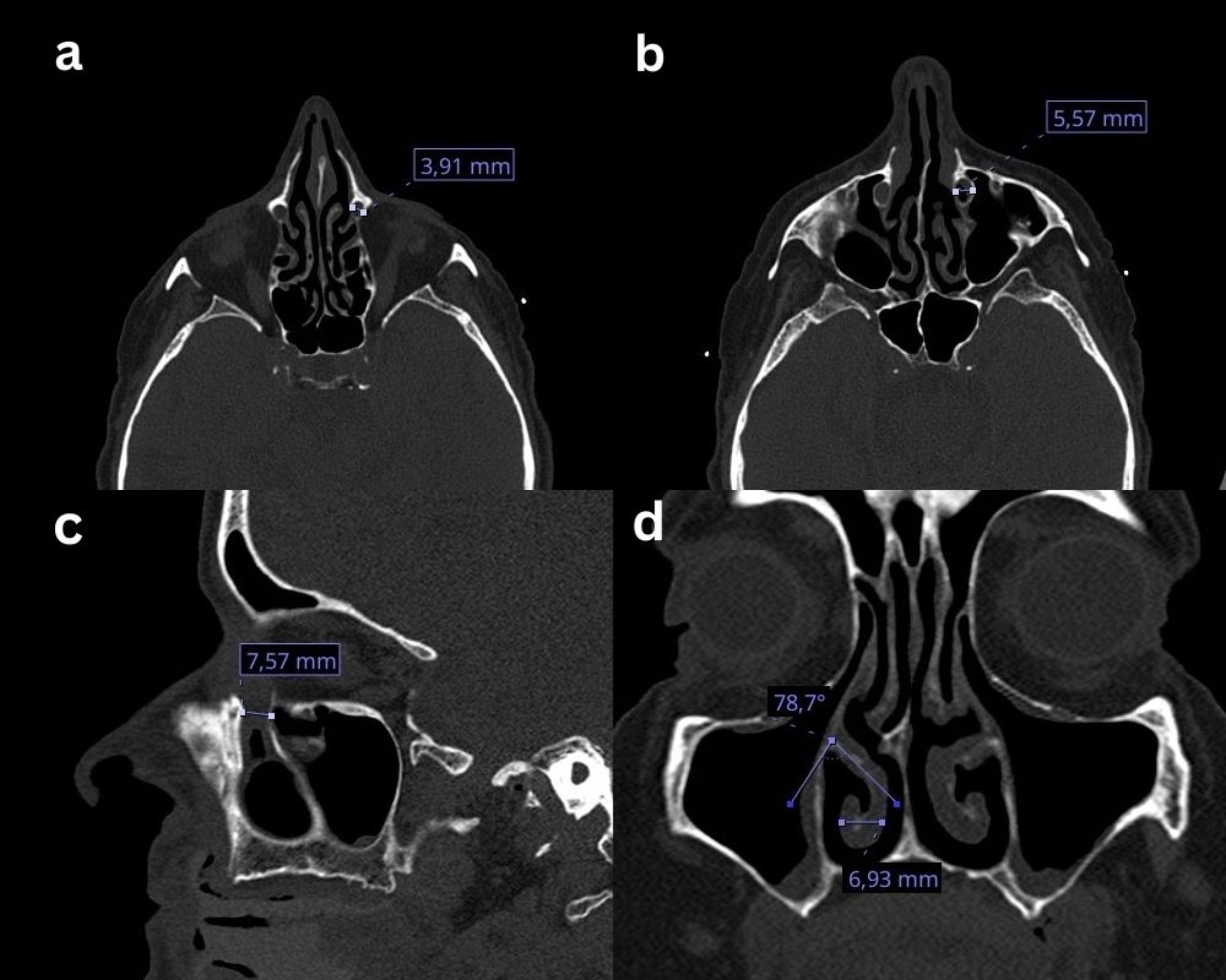 Anatomical factors behind acquired primary nasolacrimal duct obstruction and acute dacryocystitis