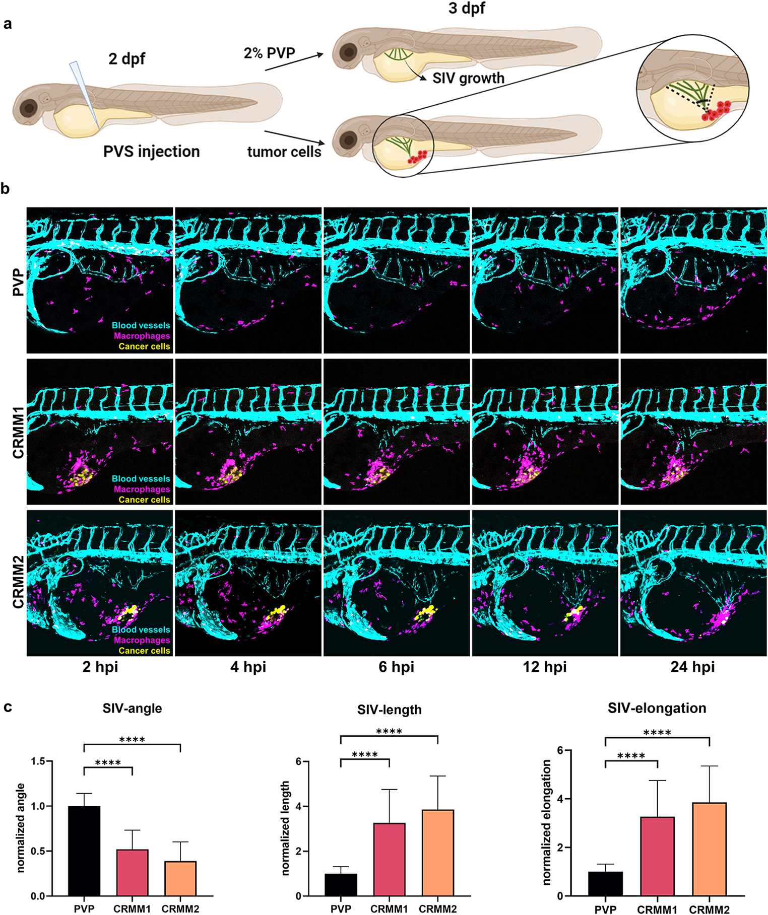 Lactate secreted by glycolytic conjunctival melanoma cells attracts and polarizes macrophages to drive angiogenesis in zebrafish xenografts